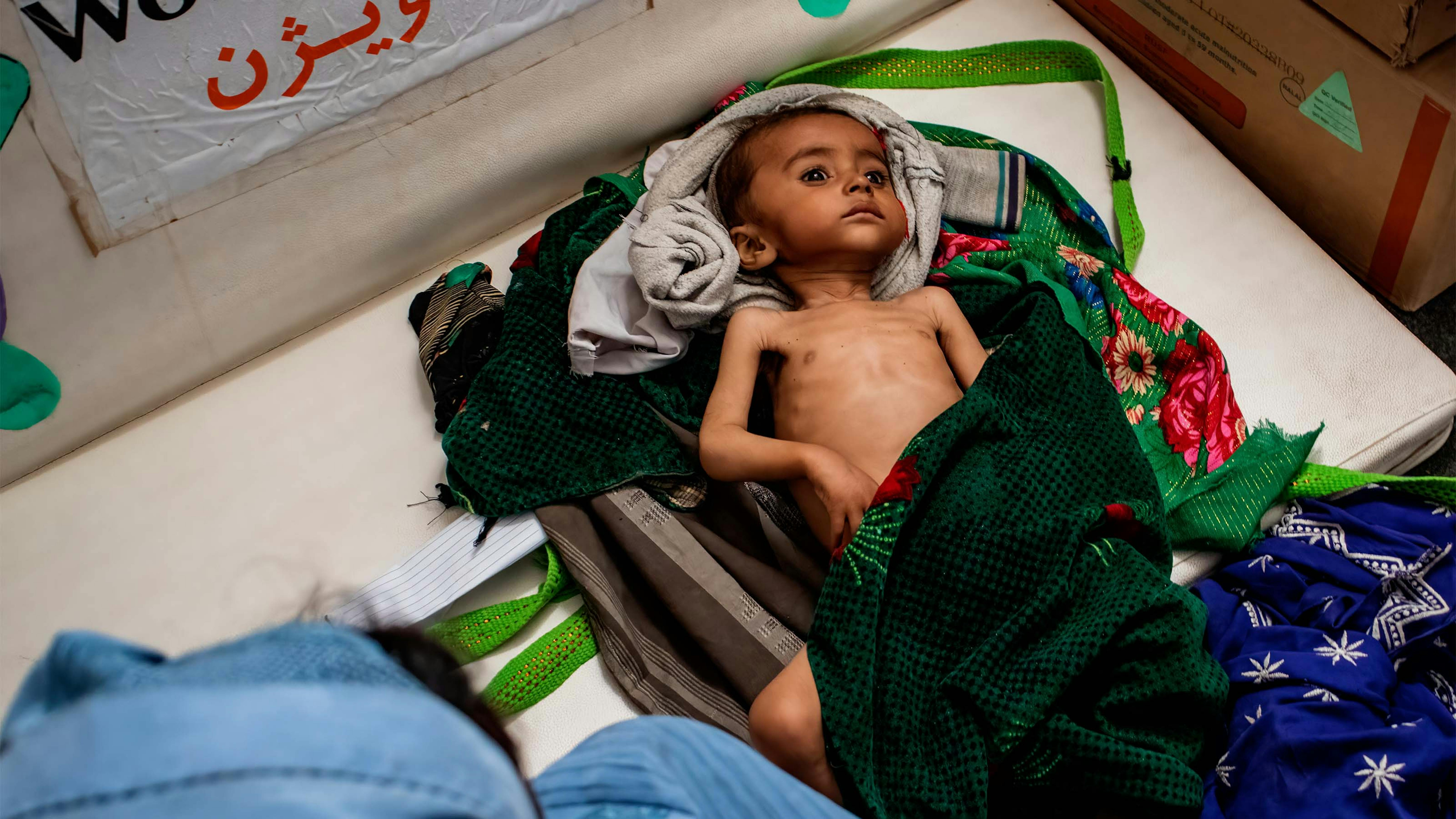 Afghanistan - Un bambino gravemente malnutrito in una clinica del Mobile Health Team supportata dall'UNICEF e dal WFP presso l'insediamento per sfollati interni di Sabz-e-Shark a Herat. 