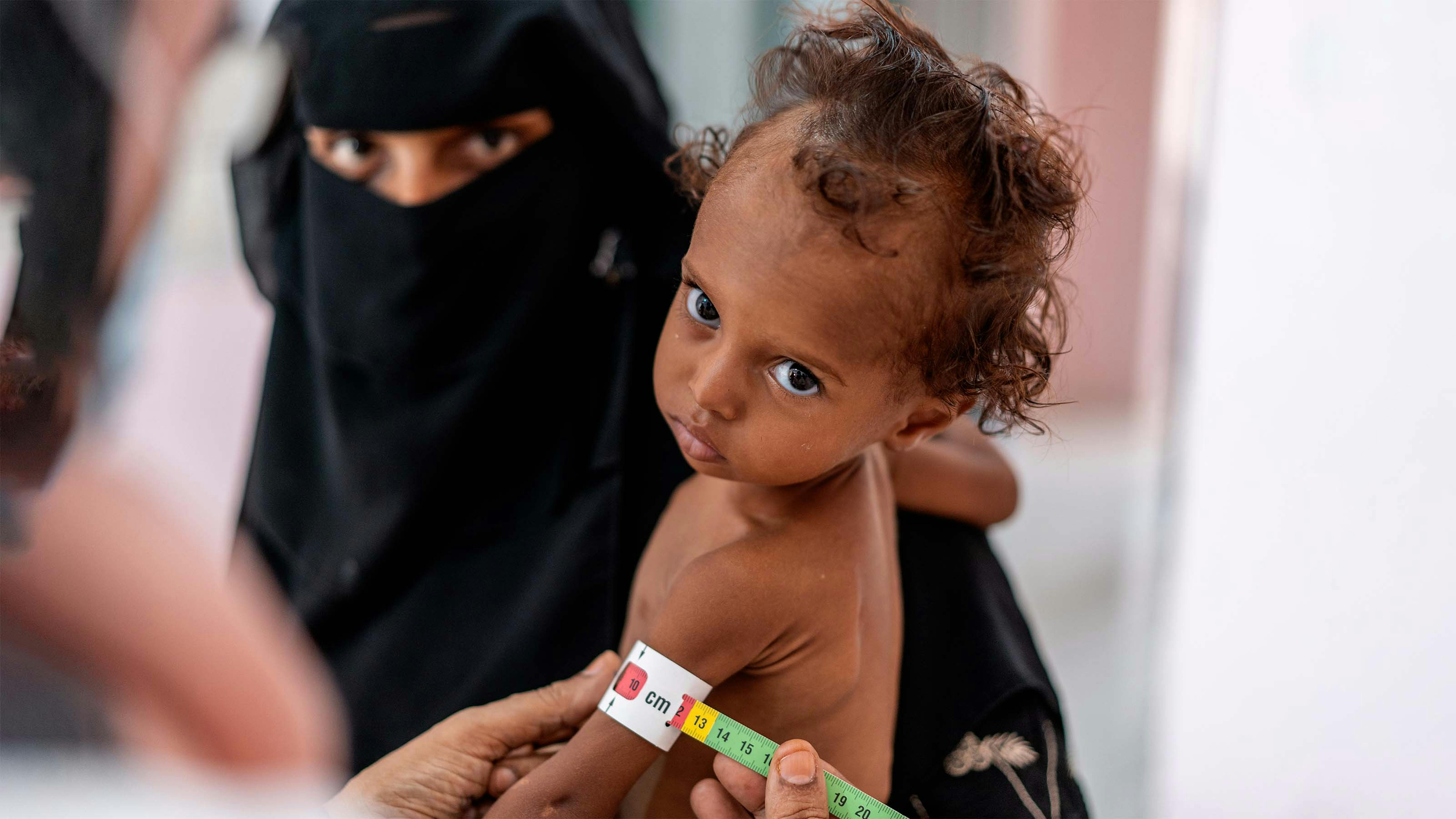 Yemen, un bambino viene monitorato per verificare lo stato nutrizionale