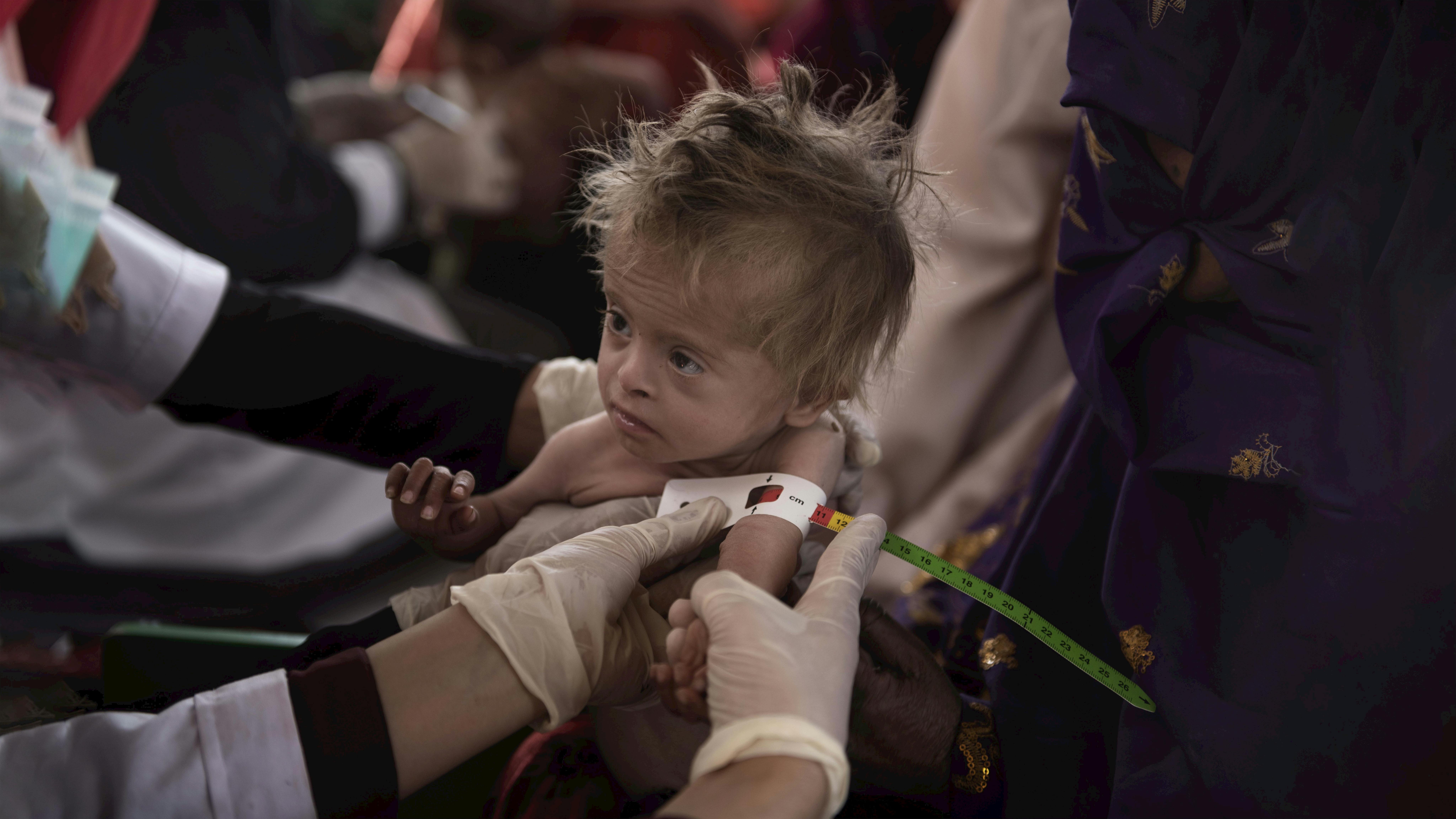 Afghanistan, Kandahar: durante una visita di un team mobile di salute e nutrizione nel villaggio di Nasaji, un'infermiera nutrizionista misura la circonferenza del braccio di un bambino per determinare il suo stato nutrizionale nel villaggio di Nasaji nella provincia di Kandahar.