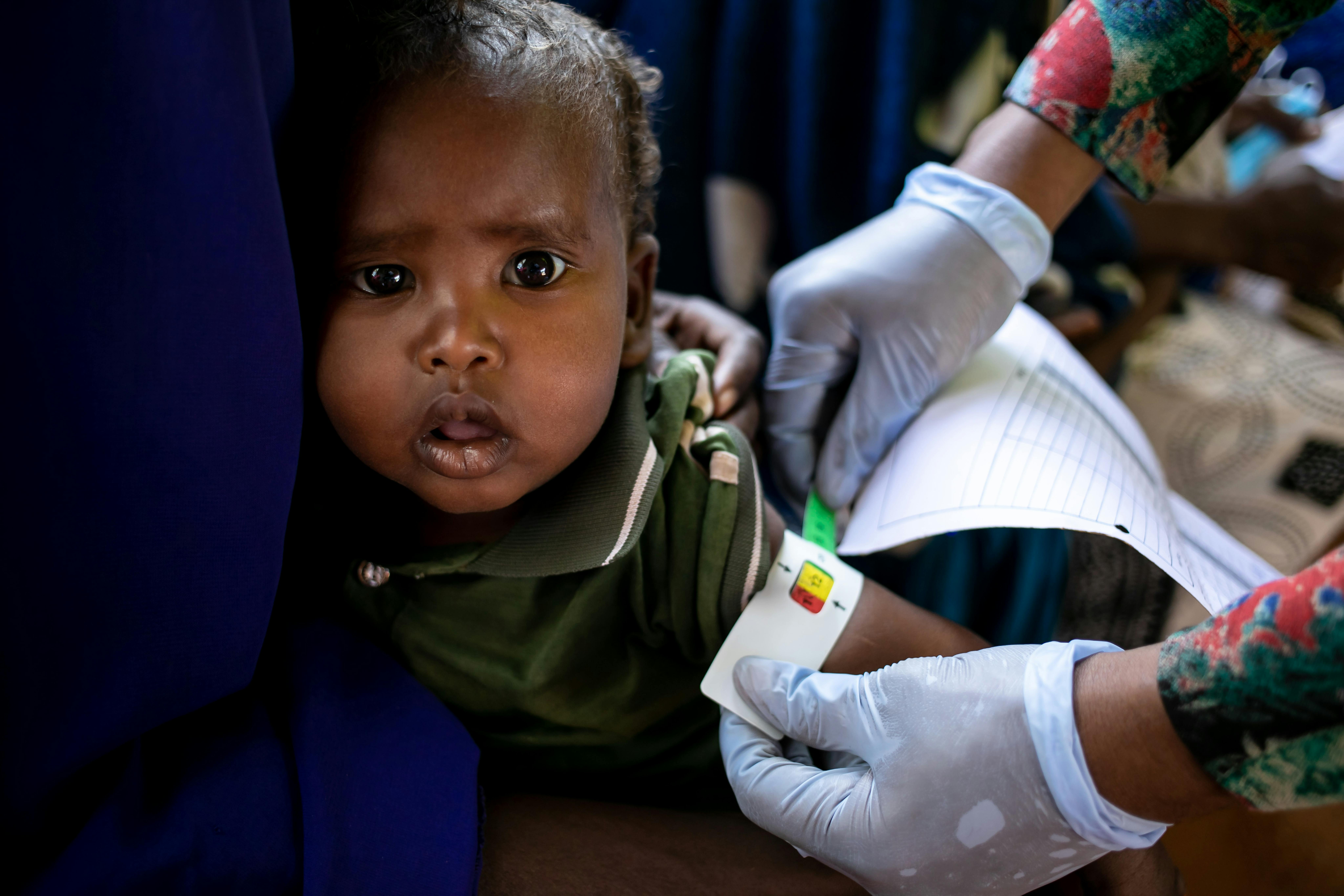 Somalia, un medico misura lo status nutrizionale a un bambino 