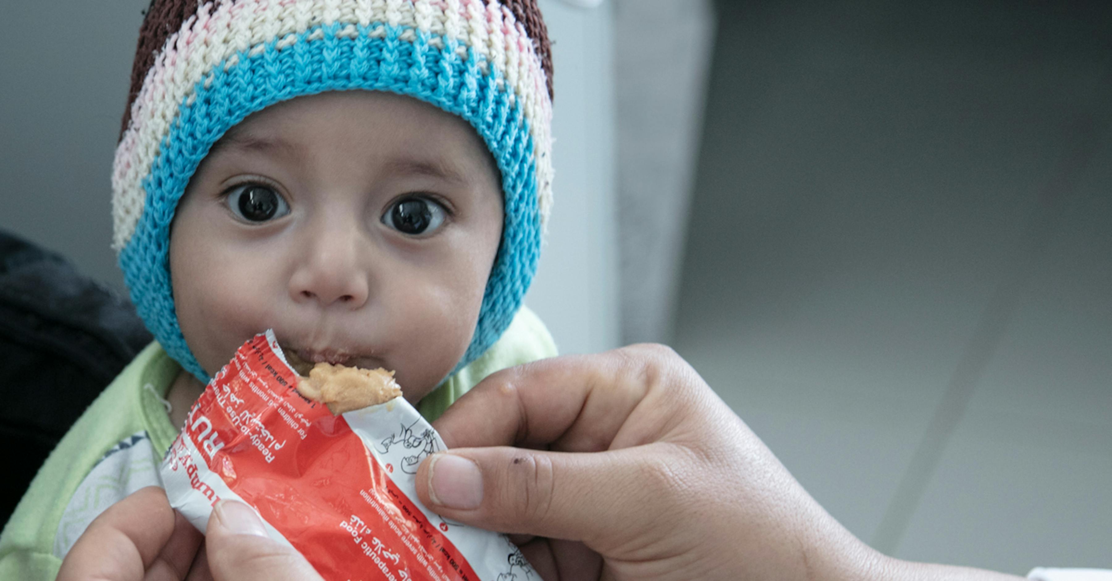 un bambino viene nutrito con un alimento terapeutico