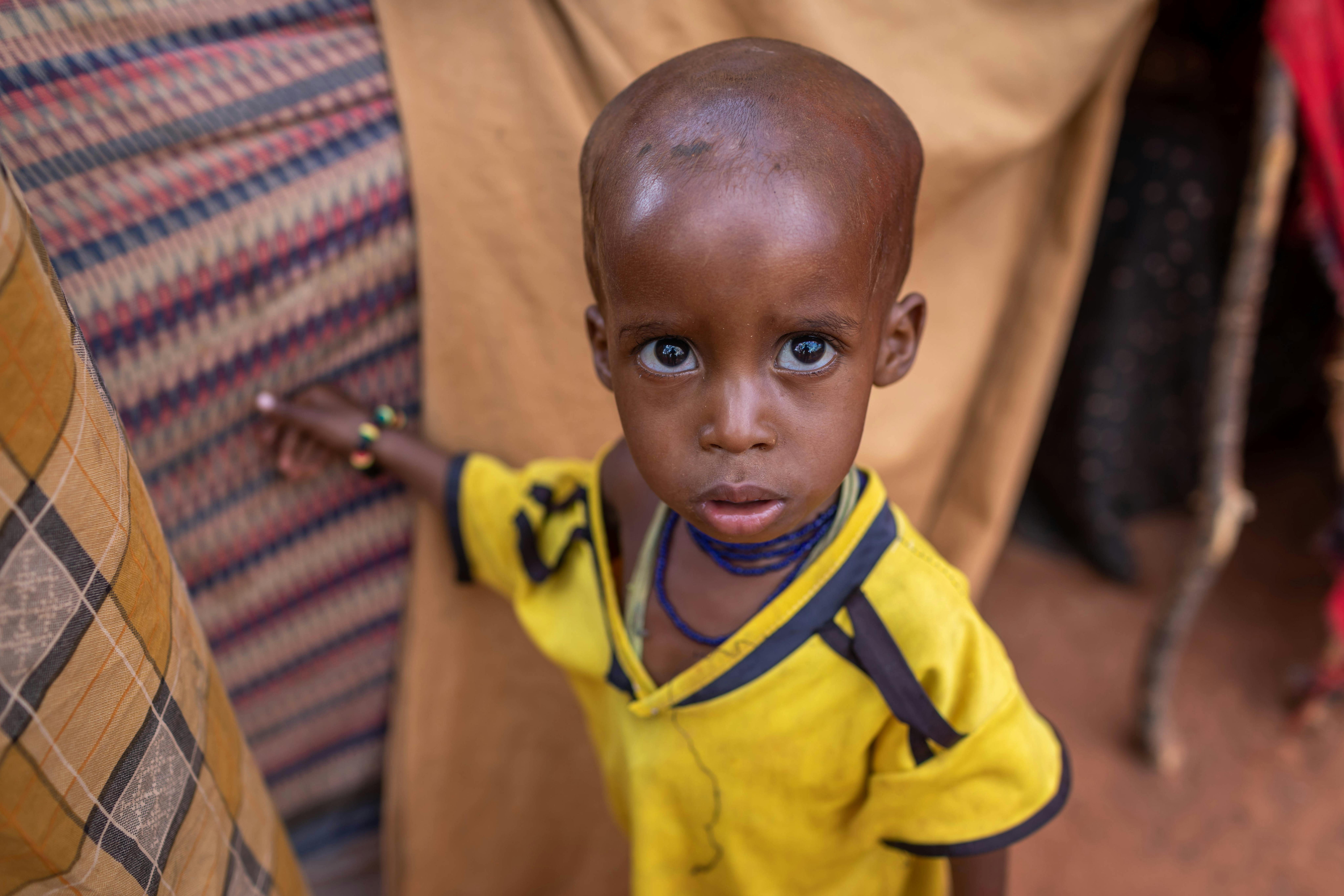 Nurto Abdulahi, 2 anni, è gravemente malnutrito. Ha bisogno di un trattamento terapeutico urgente. Nurto e la sua famiglia sono sfollati a causa della recente siccità e si trova nel campo per rifigiati interni di  Burdhubo ad Afdhes, in Etiopia