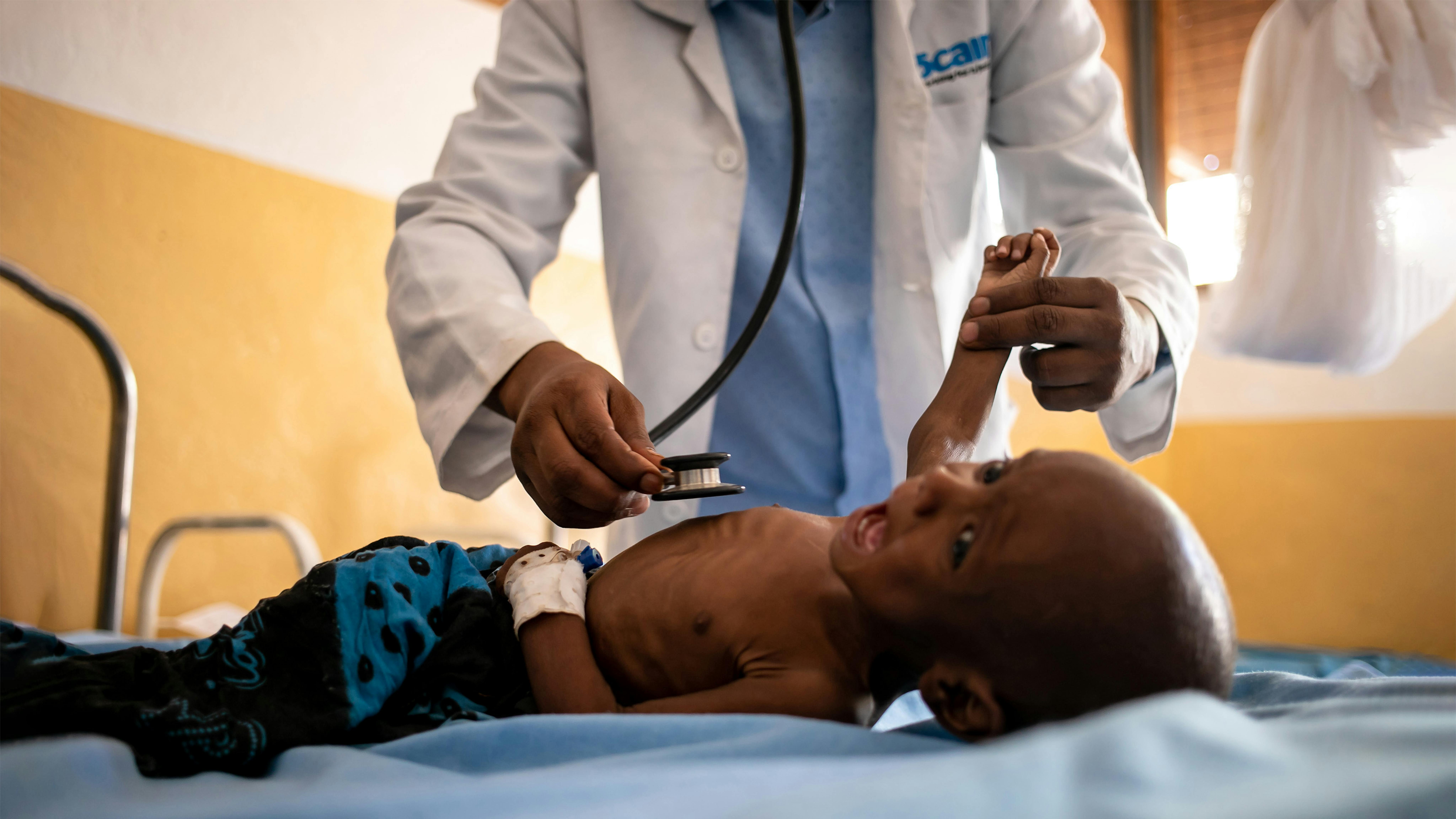 Somalia, Salman Issaq Cawil, un bambino malnutrito di un anno viene visitato in un reparto dell'ospedale di Dolow