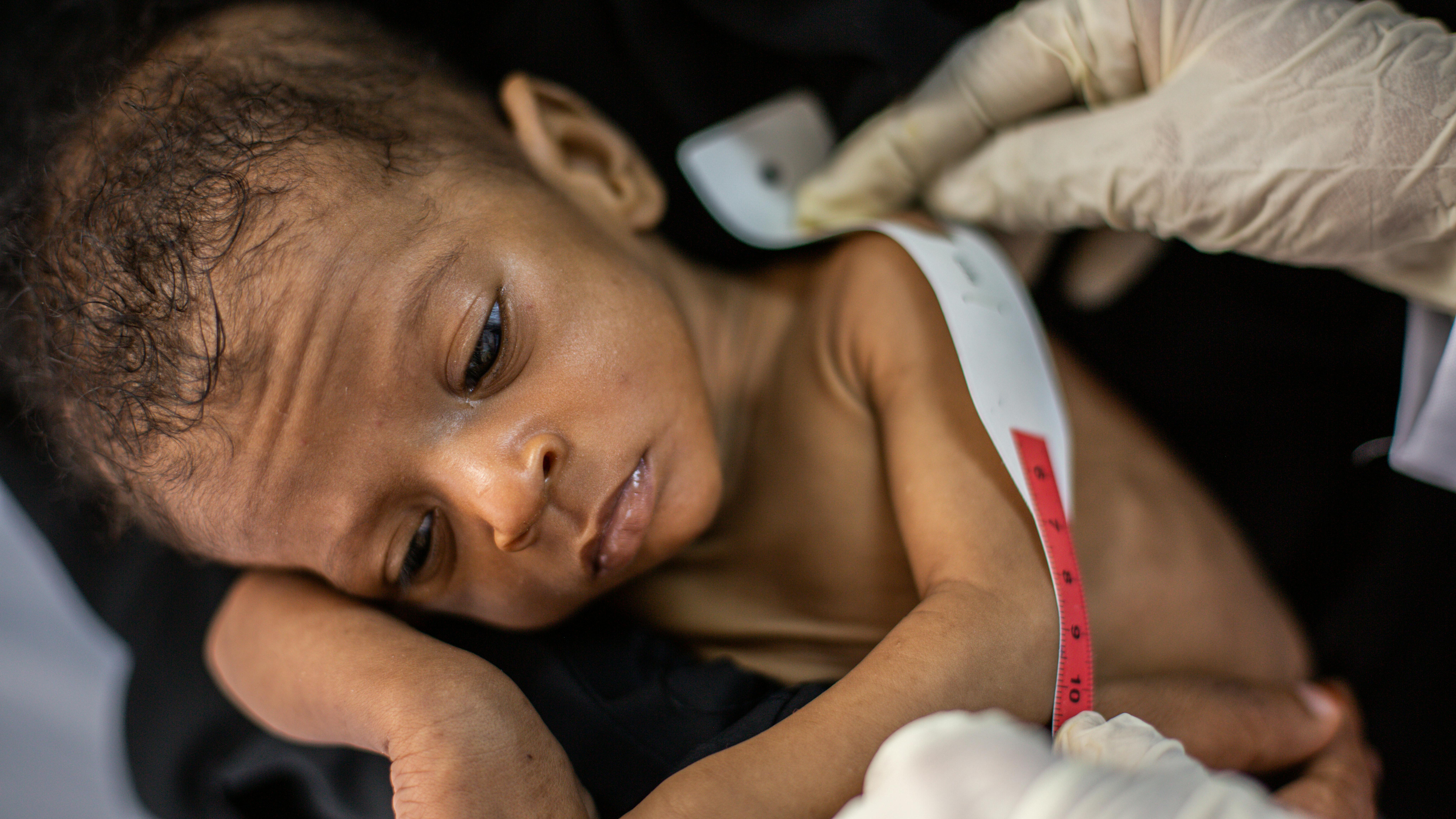 Rajwa, un bambino di sette mesi, soffre di malnutrizione. È in cura presso il TFC di Alqutae, Al Hudaidah, Yemen.