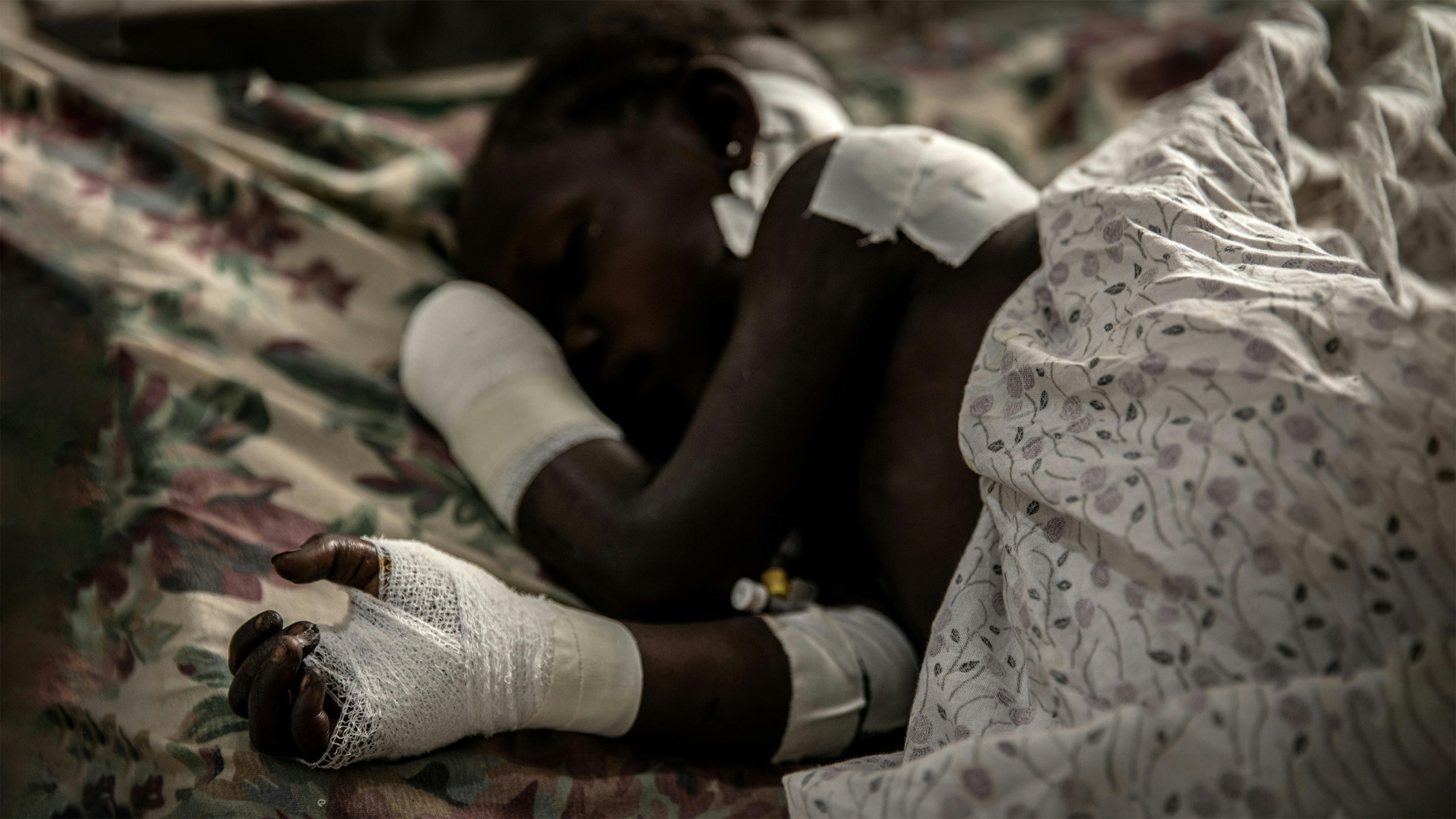 Congo - Una bambina vittima di una mutilazione ne letto dell'ospedale di Bunia