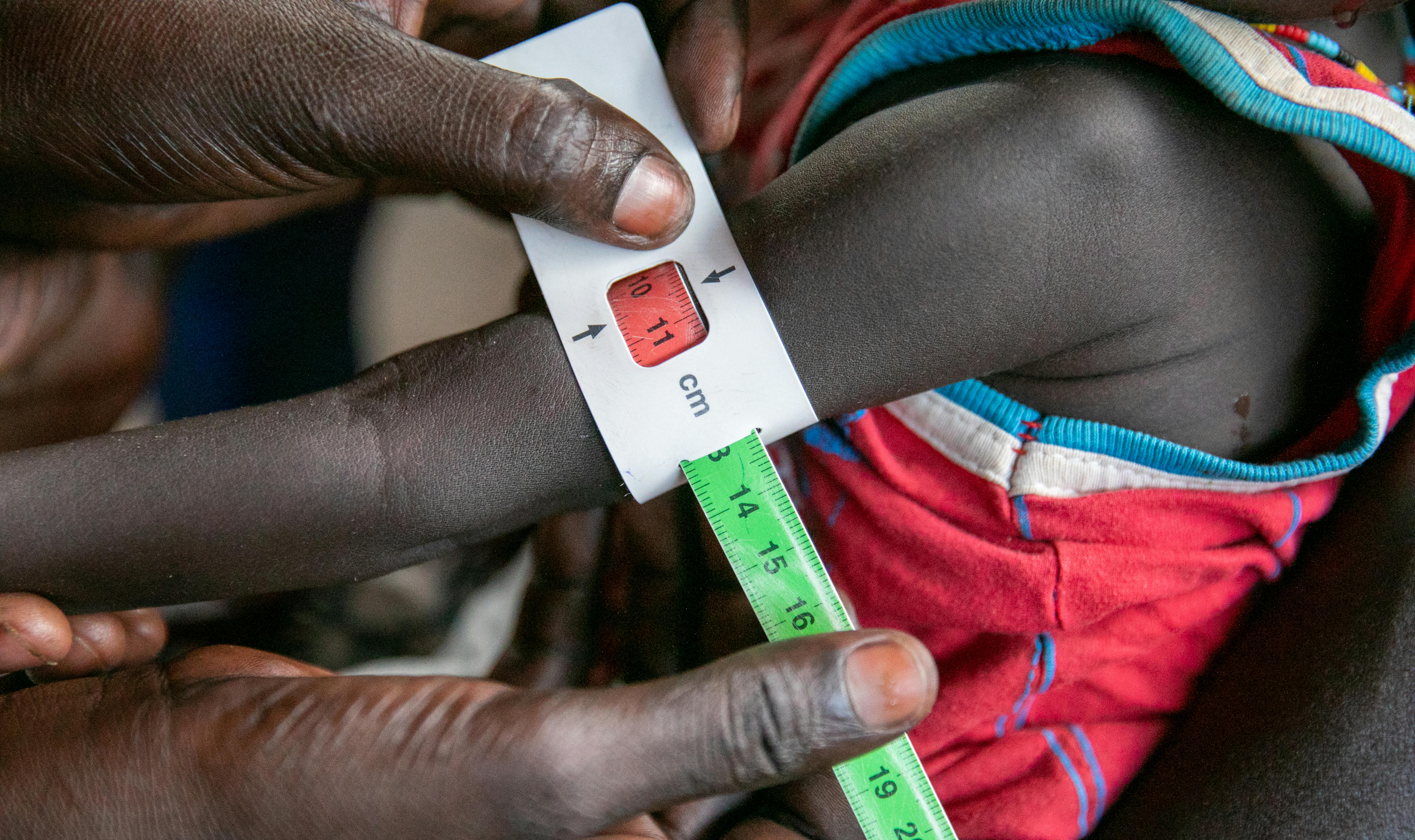 Sud Sudan - La misurazione dello status nutrizionale mostra che questo bambino è malnutrito© WFP/WF1668423