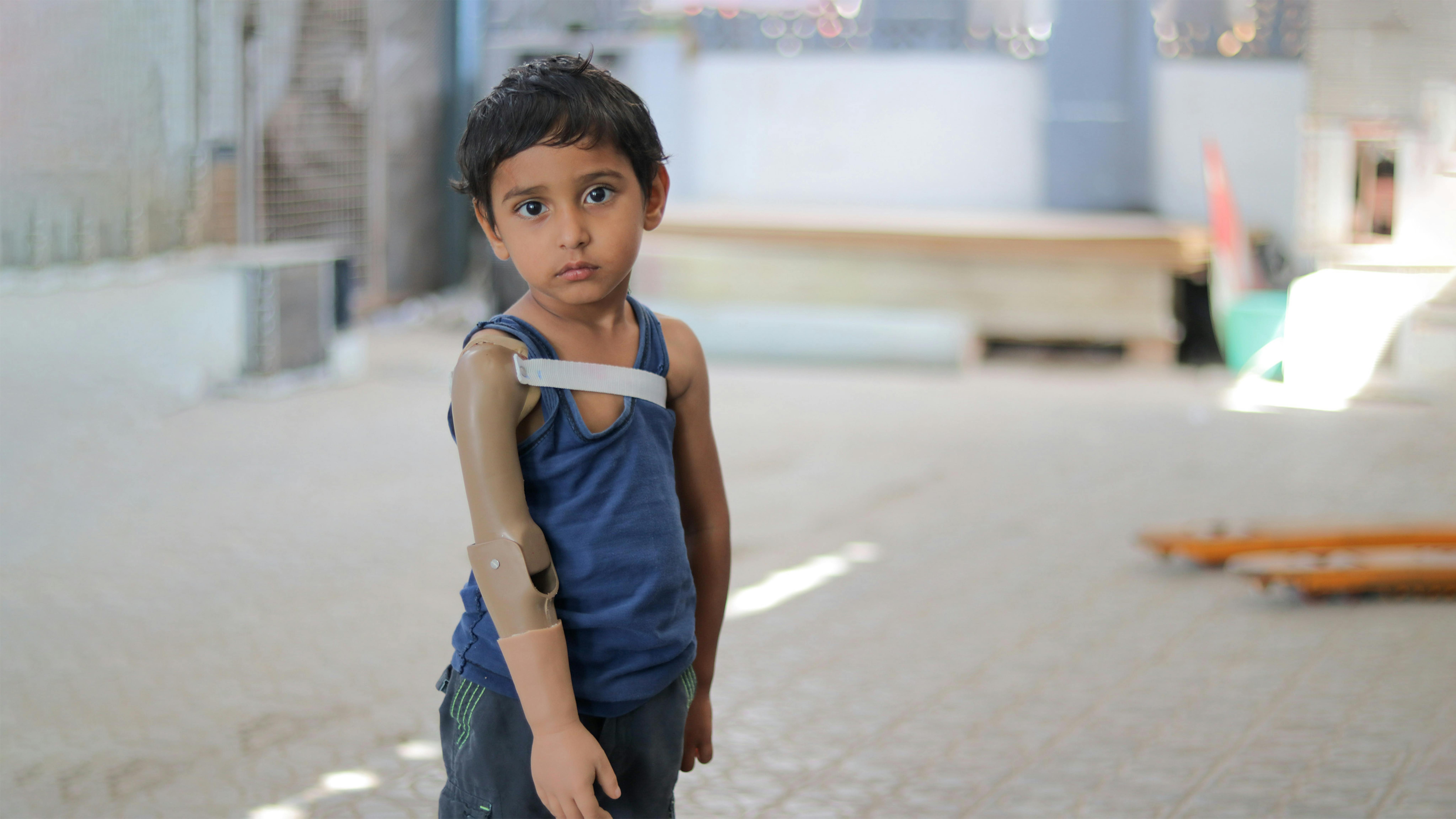 Rayan, che ora ha tre anni, ha perso il braccio l'anno scorso quando i combattimenti si sono intensificati ad Aden.
