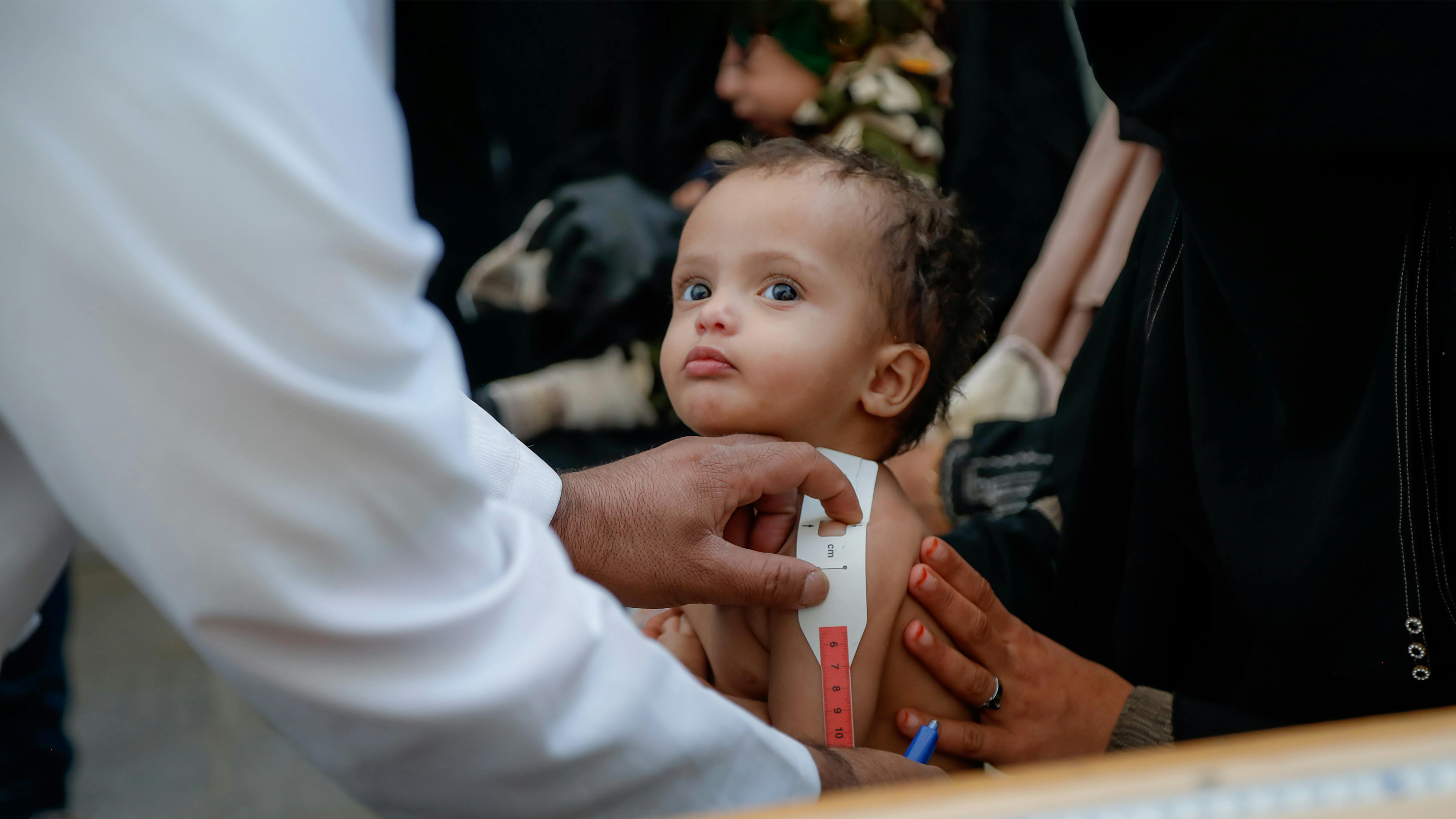 Yemen - Un medico sta visotando con  il MUAC  Jana, di 20 mesi, al centro nutrizionale
