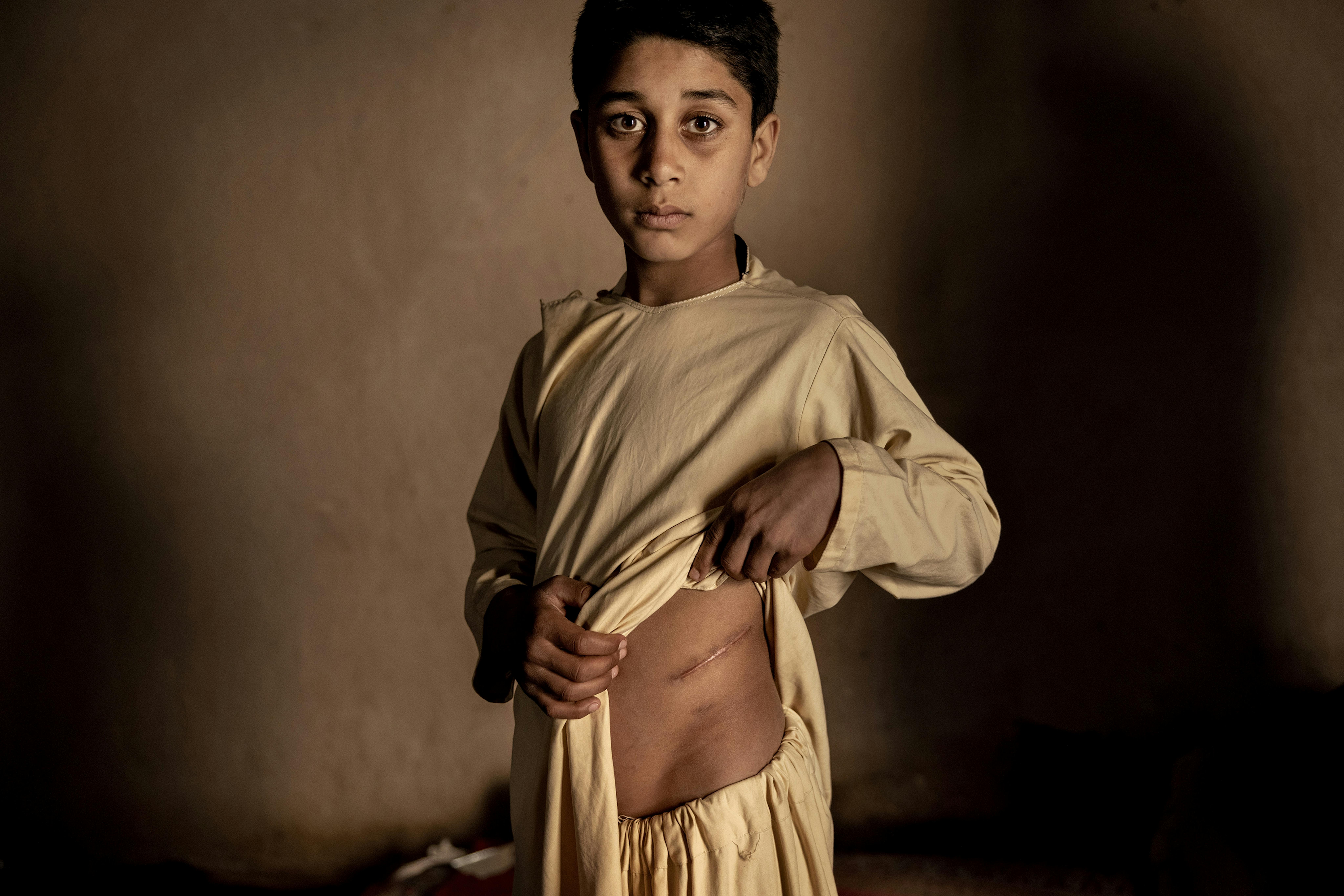 © Mads Nissen, Denmark, Politiken, Agency laif - Il prezzo della pace (Afghanistan): Il quindicenne Khalil Ahmad ha dovuto sacrificare il suo rene sinistro per volere dei suoi genitori. Avevano urgente bisogno di soldi per nutrire i loro undici figli.