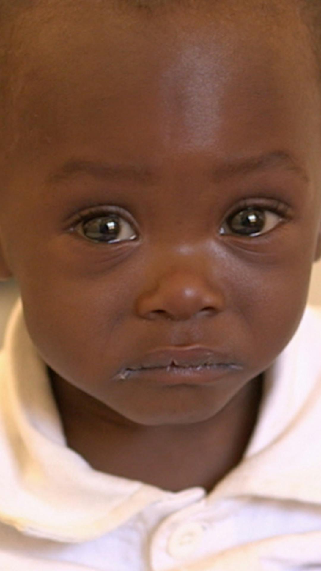 pledge malnutrizione - salva i bambini