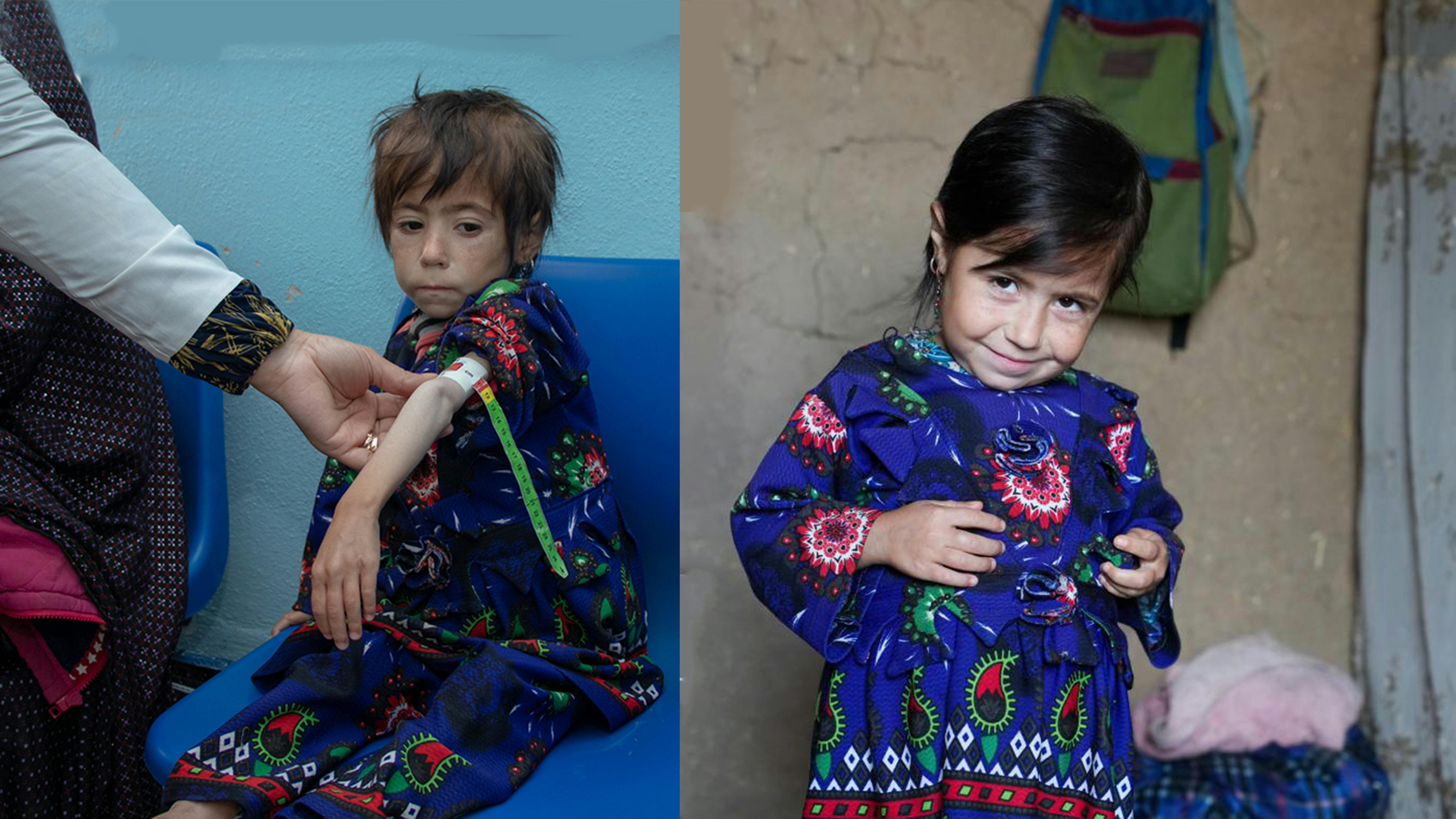 Parwana, bambina afghana malnutrita, prima e dopo