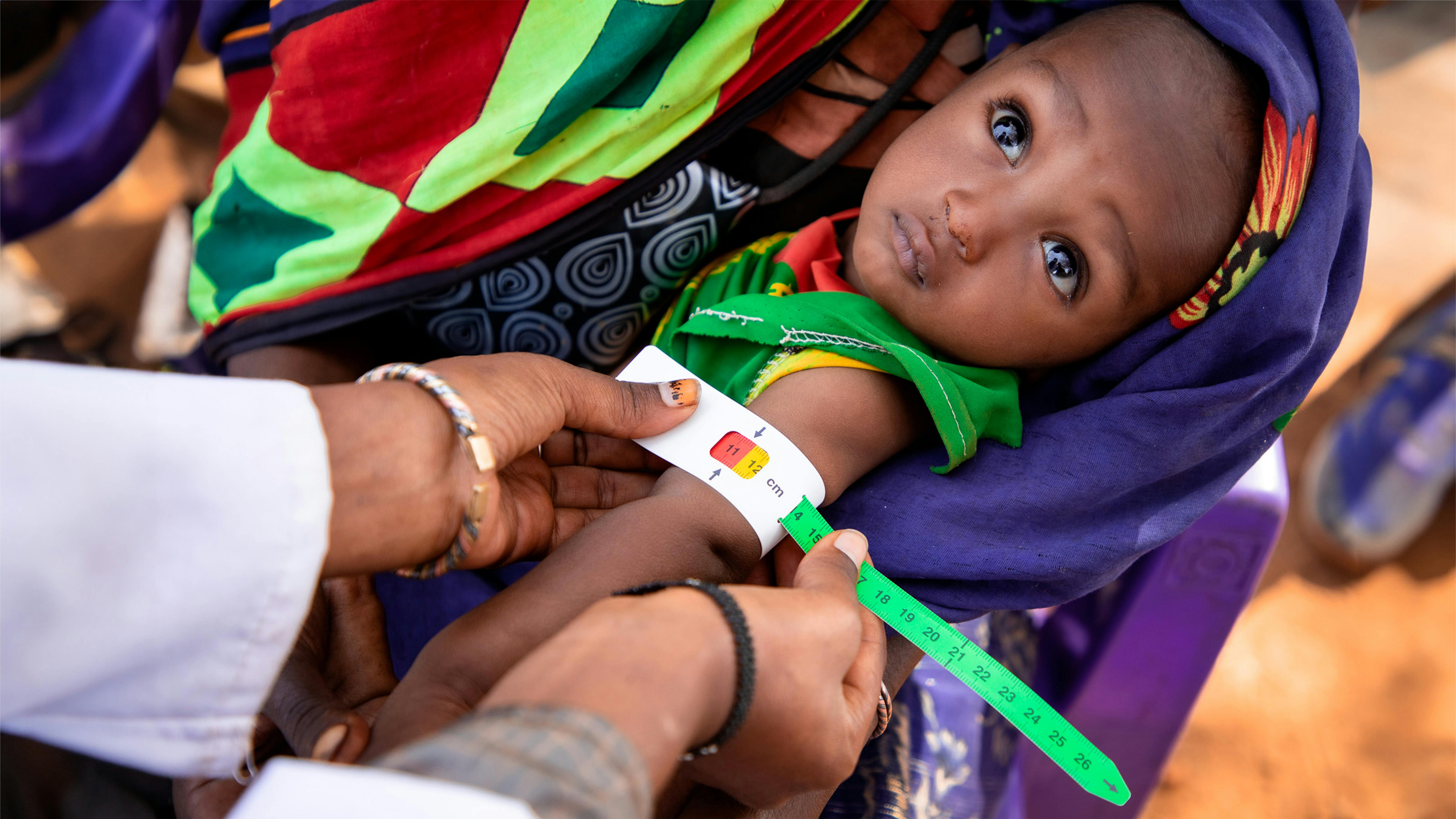 Etiopia, un  bambino viene visitato per verificare lo status nutrizionale
