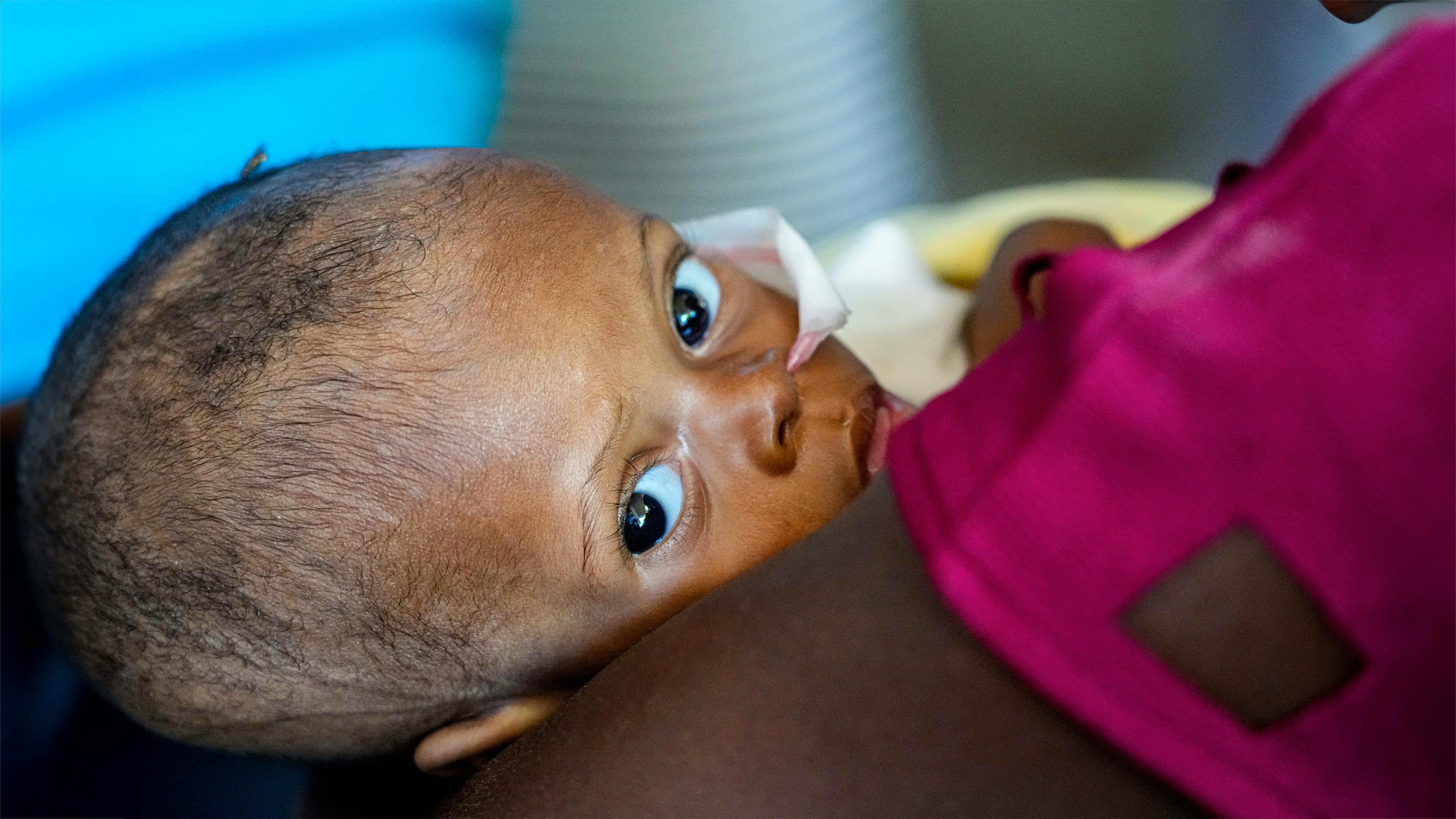 Haiti - Ospedale universitario La Paix,  un bambino in attesa dello screening e del trattamento della malnutrizione.