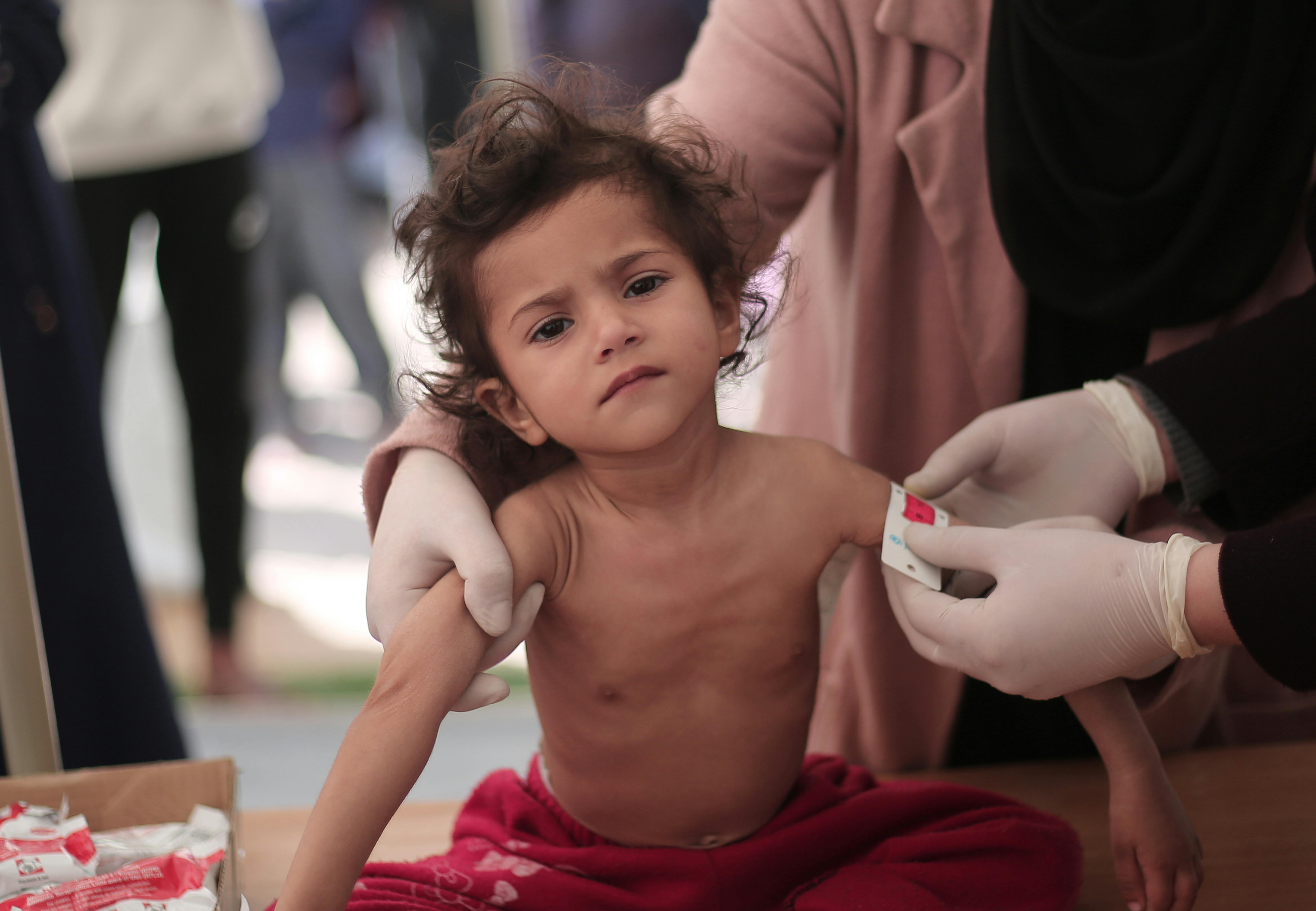 Leen, 2 anni, mentre le viene misurata la circonferenza del braccio medio-superiore (MUAC), il suo MUAC è inferiore a 10, il che indica una grave malnutrizione acuta e una drastica perdita di peso e atrofia muscolare. Prima della guerra, riceveva attivamente farmaci appropriati e fisioterapia, che l'hanno aiutata a raggiungere gli 11 chilogrammi di peso e ha mostrato segni di miglioramento della salute