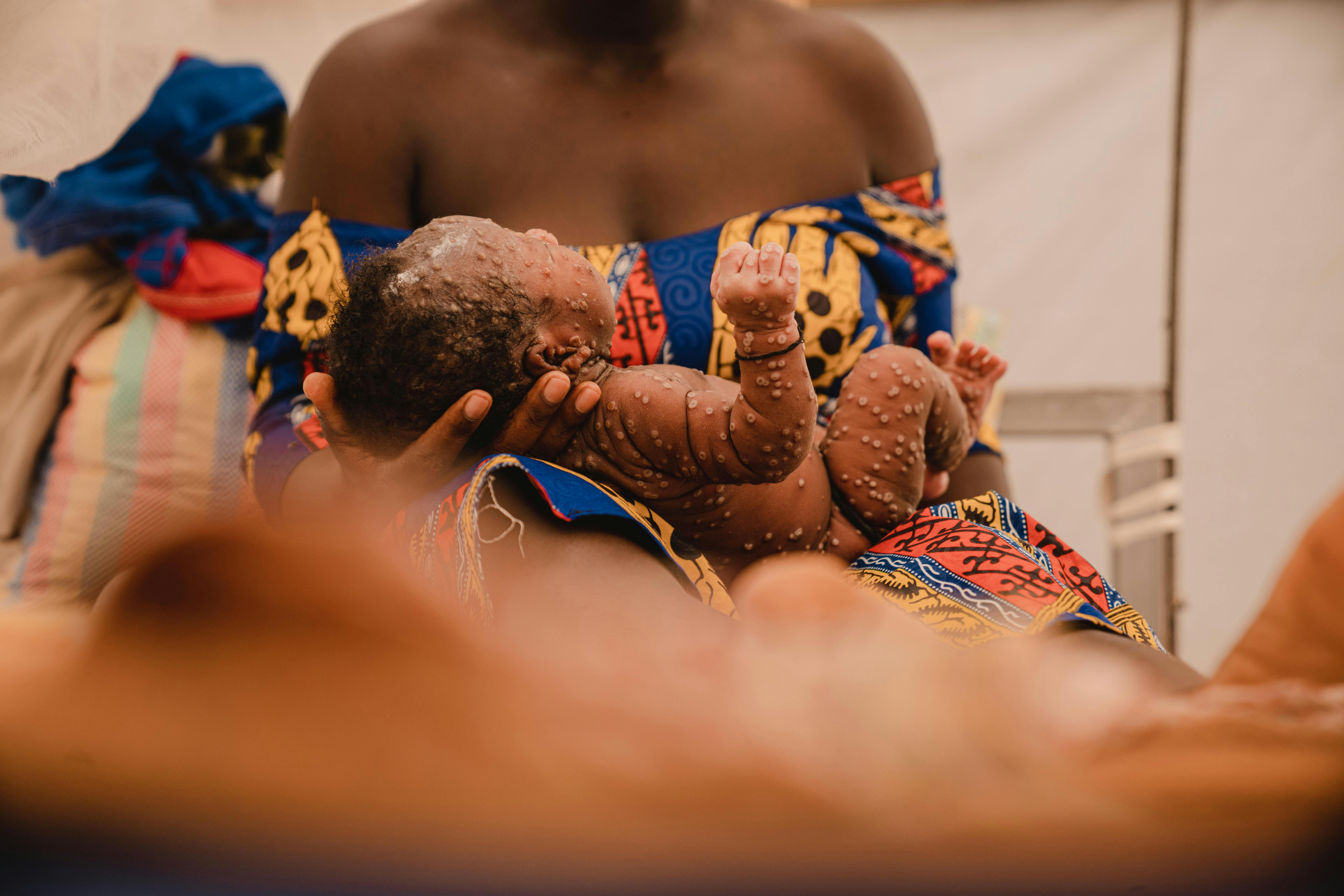 Aline (nome d'invenzione), un mese, tra le braccia della madre presso l'unità di isolamento mpox dell'ospedale Kamanyola, sostenuto dall'UNICEF, nella provincia del Sud Kivu, nella Repubblica Democratica del Congo, il 24 luglio 2024.