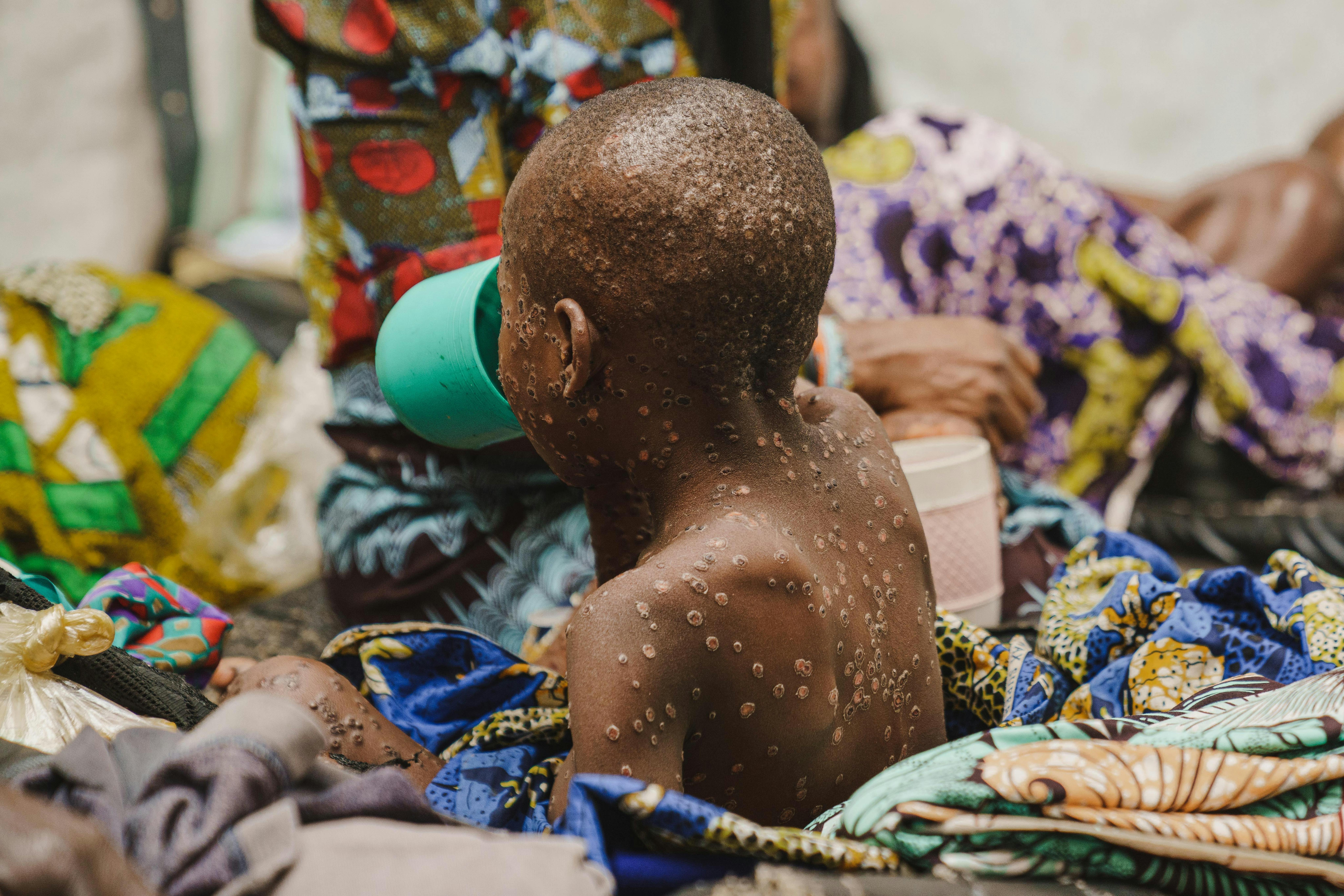 Un bambino affetto da mpox nell'unità di isolamento per mpox dell'ospedale Kavumu supportato dall'UNICEF nella provincia del Sud Kivu, nella Repubblica Democratica del Congo
