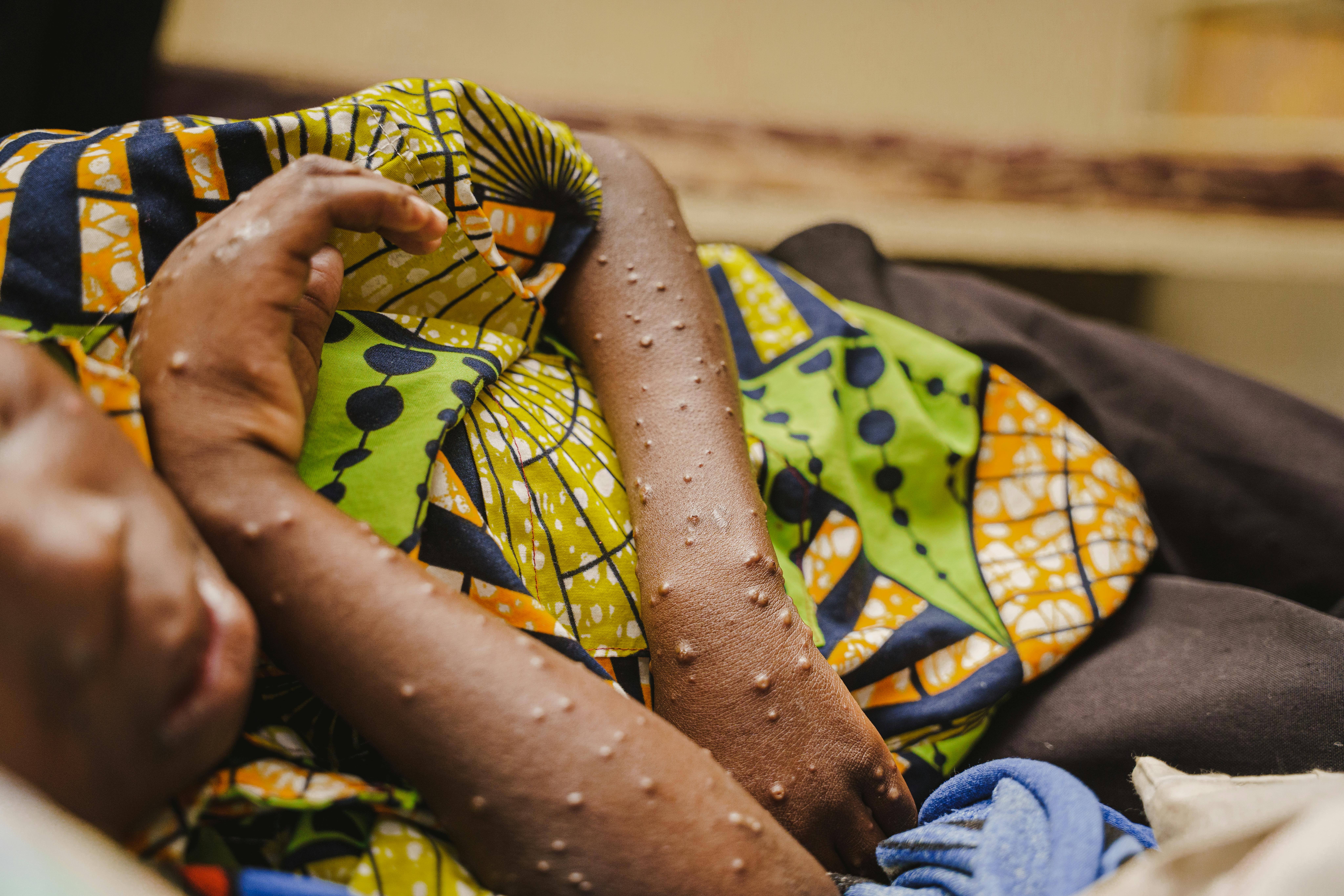 Un piccolo paziente riceve cure per l'mpox presso l'unità di isolamento e trattamento dell'ospedale Lwiro, sostenuto dall'UNICEF, nella provincia del Sud Kivu, nella Repubblica Democratica del Congo.