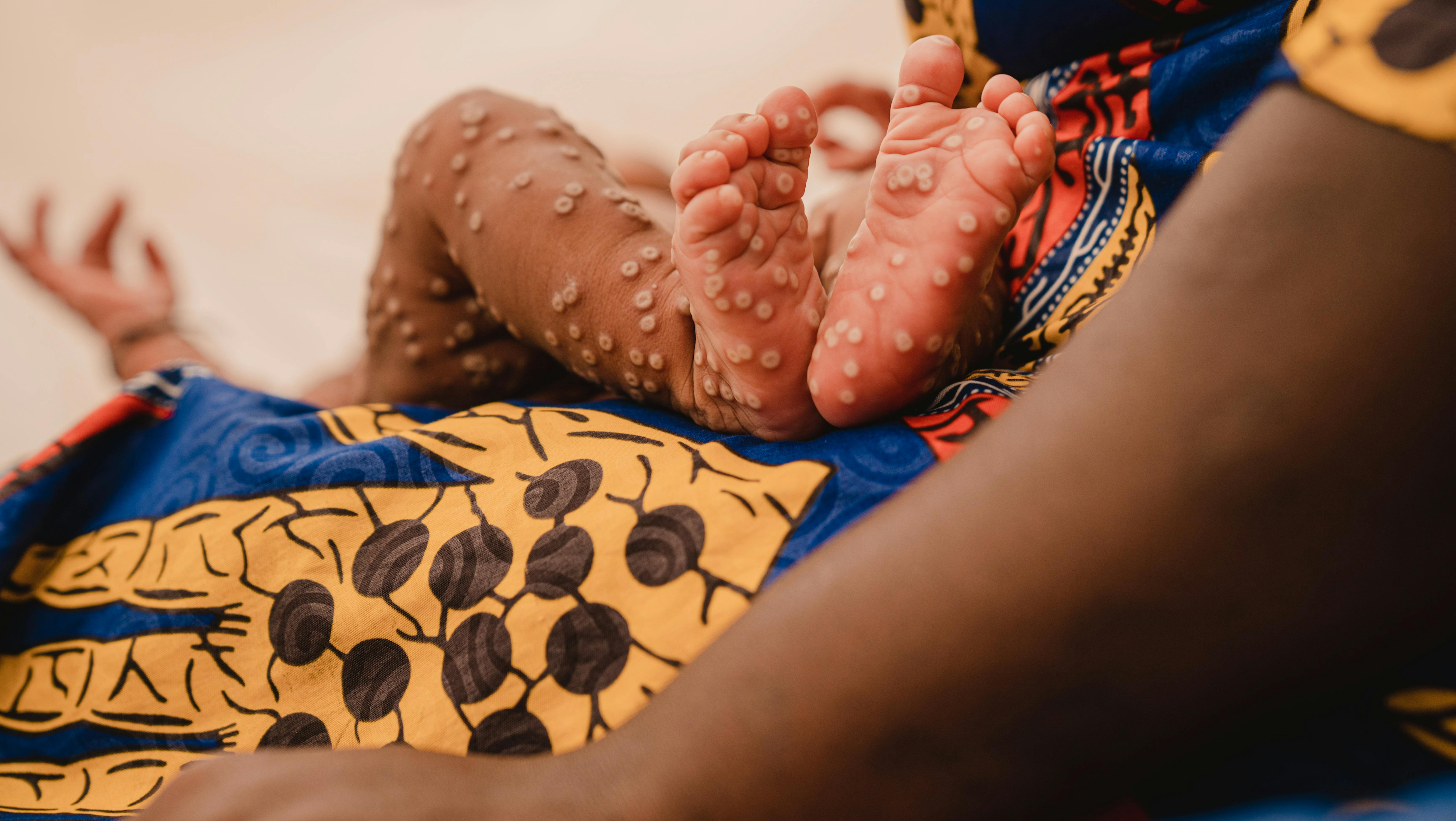 Congo - Una madre tiene in braccio il suo bambino nell'unità di isolamento Mpox nella provincia del Sud Kivu
