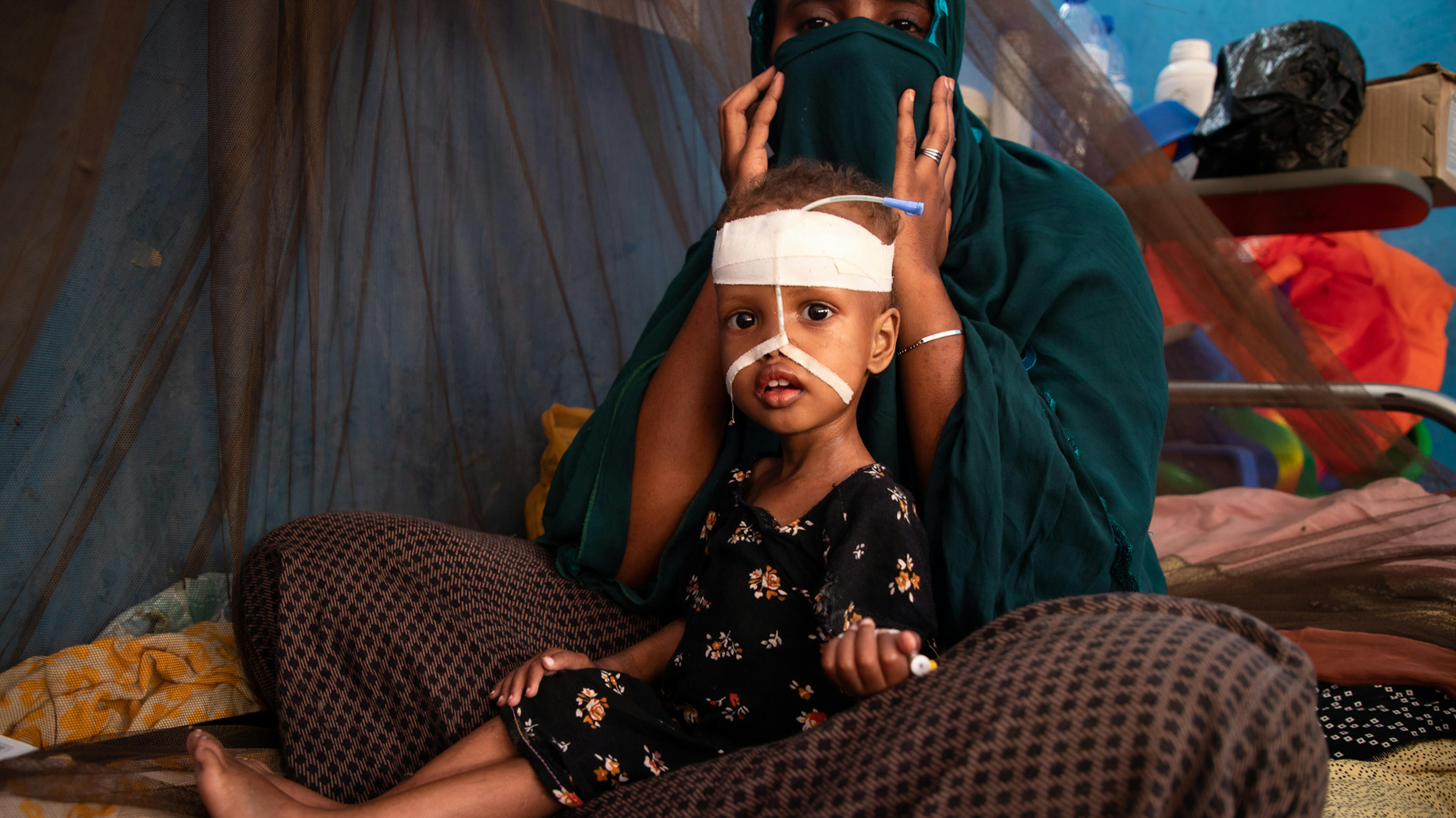 Etiopia - Mouna, 2 anni, soffre di malnutrizione acuta grave. È in cura presso il centro di stabilizzazione sostenuto dall'UNICEF a Gode, nella regione somala.