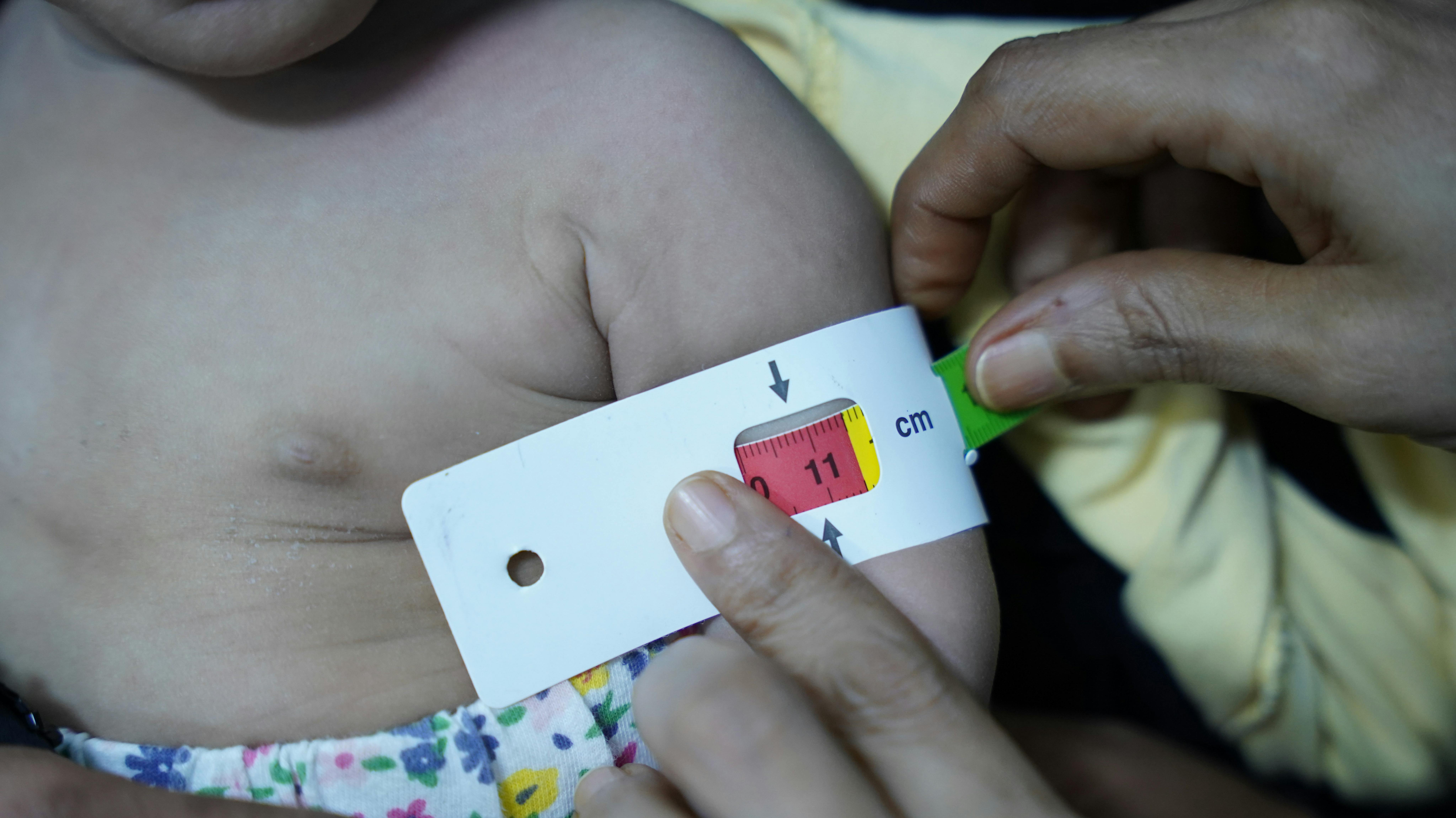 Yemen - Marwa Saddam, 8 mesi. Soffre di malnutrizione