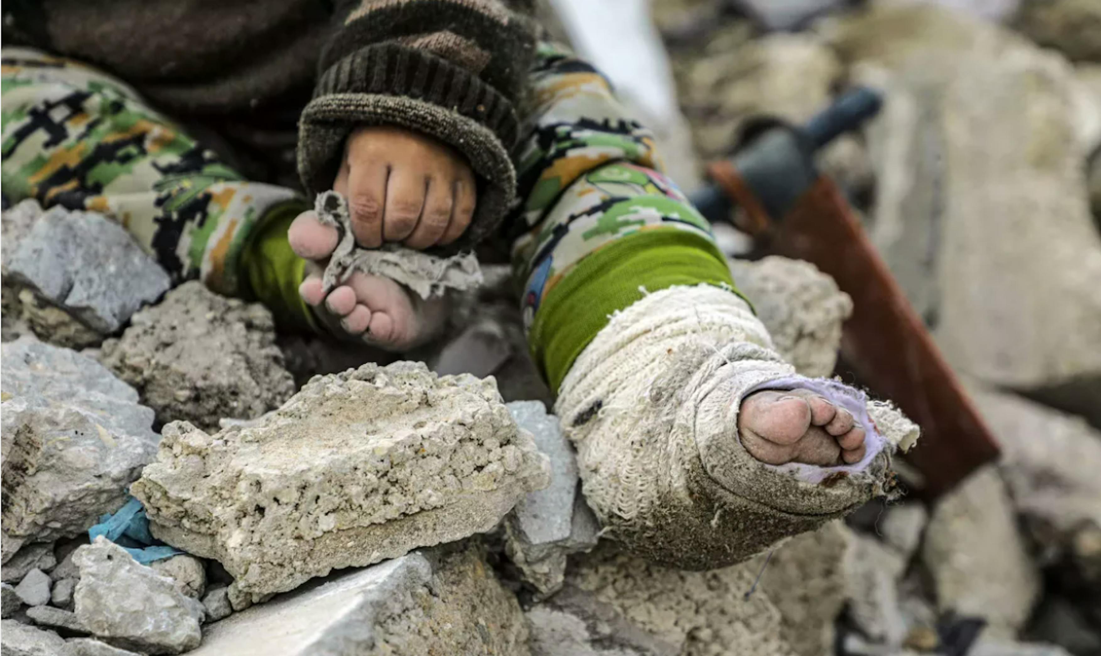 Il piccolo Adel al-Nijma ha una ustione che necessita essere curata e mantenuta pulita. Cosa impossibile, considerando che la famiglia riesce a malapena a soddisfare il proprio fabbisogno idrico e vive tra la polvere e le macerie di Gaza