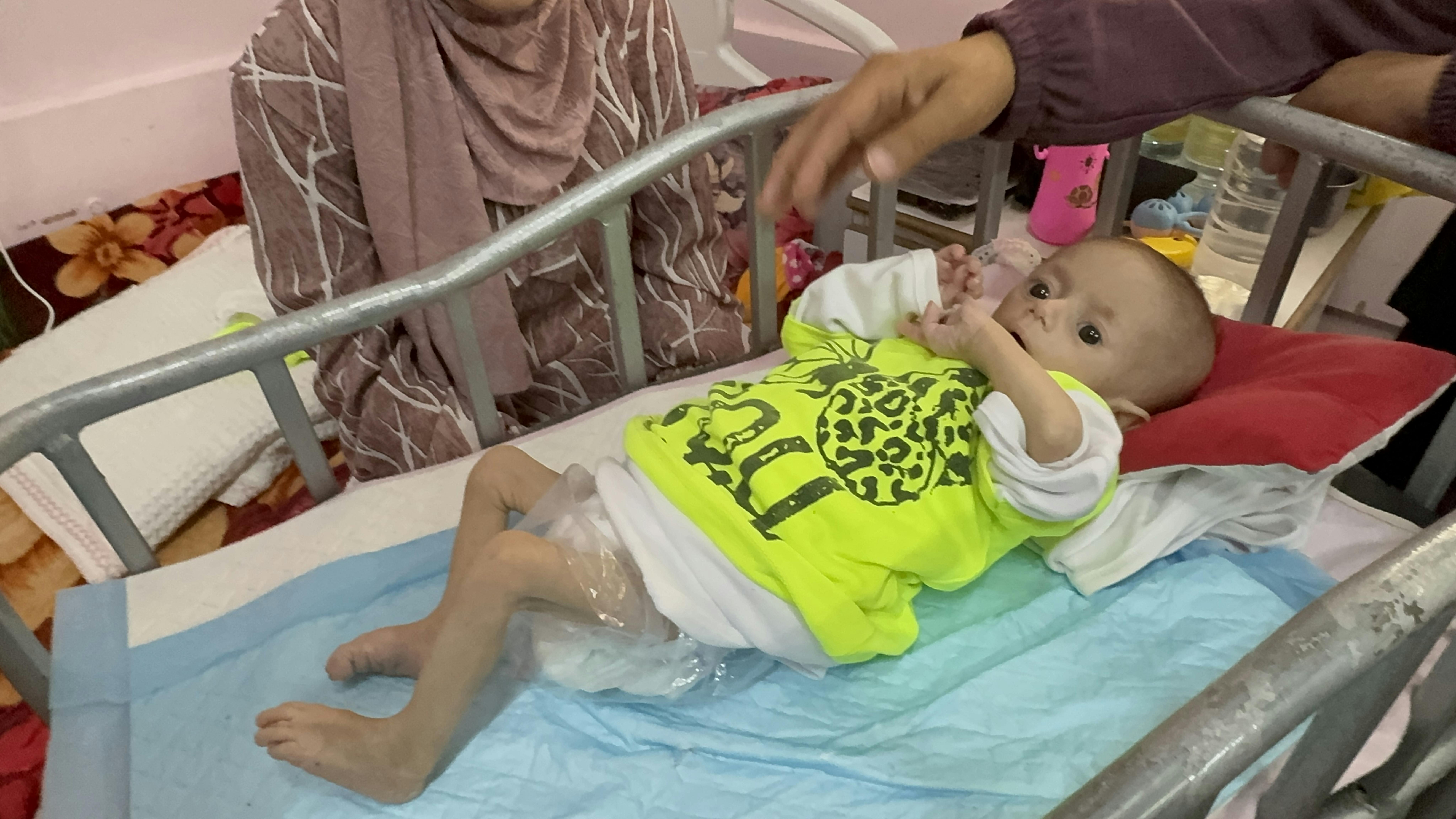 Stato di Palestina -  Sewar, 5 mesi, è stato visitato nel Centro di stabilizzazione dell'ospedale Nasser nella Striscia di Gaza, gravemente malnutrito e pericolosamente sottopeso. Sewar è nata sana, ma a causa della continua carenza di aiuti è diventata gravemente malnutrita.