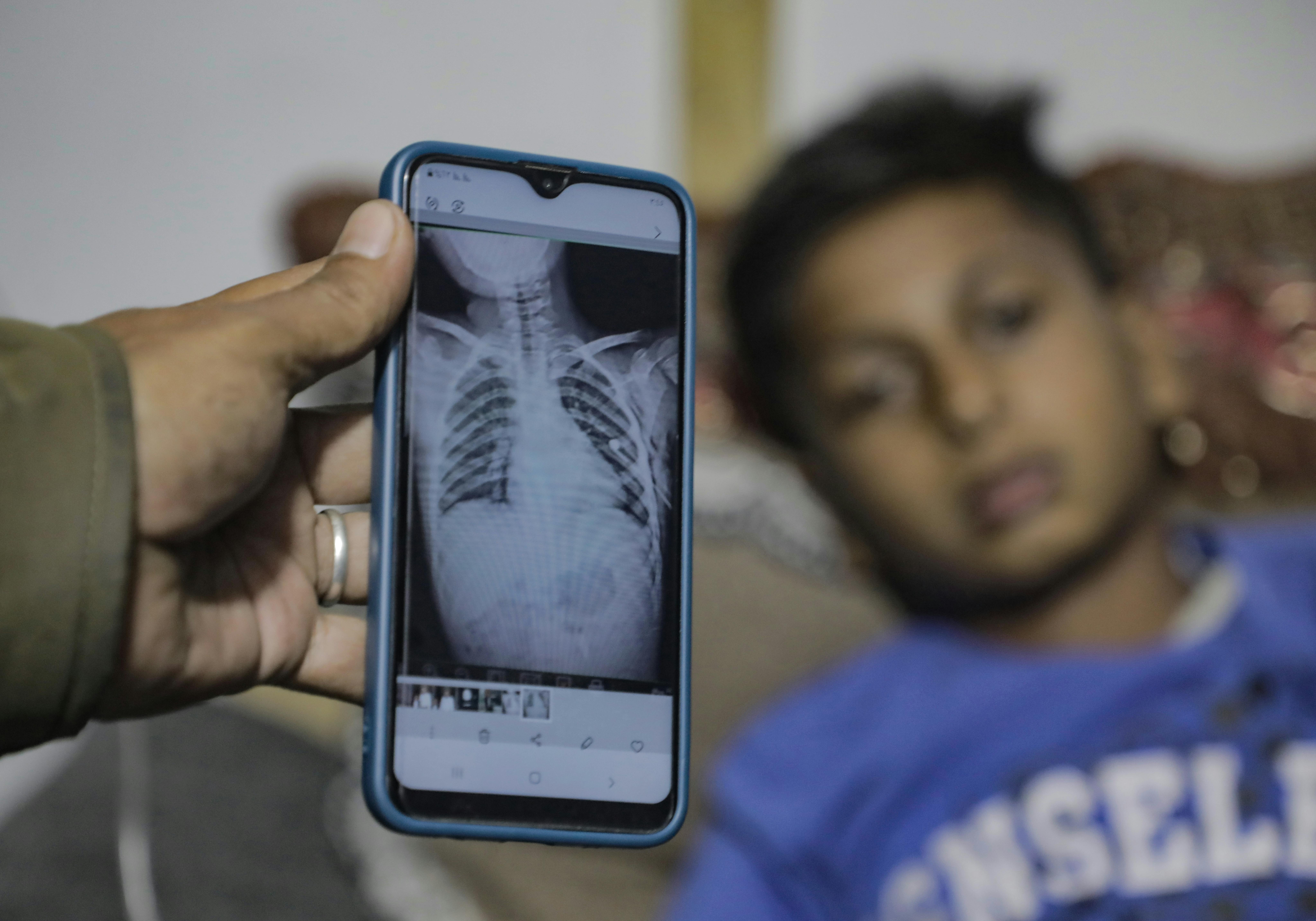 Il tredicenne Khaled Al-Dahdouh riceve cure urgenti presso l'Ospedale Battista Arabo Al-Ahli dopo essere stato ferito da un drone vicino a casa sua nel quartiere di Al-Zaytoun a Gaza City.