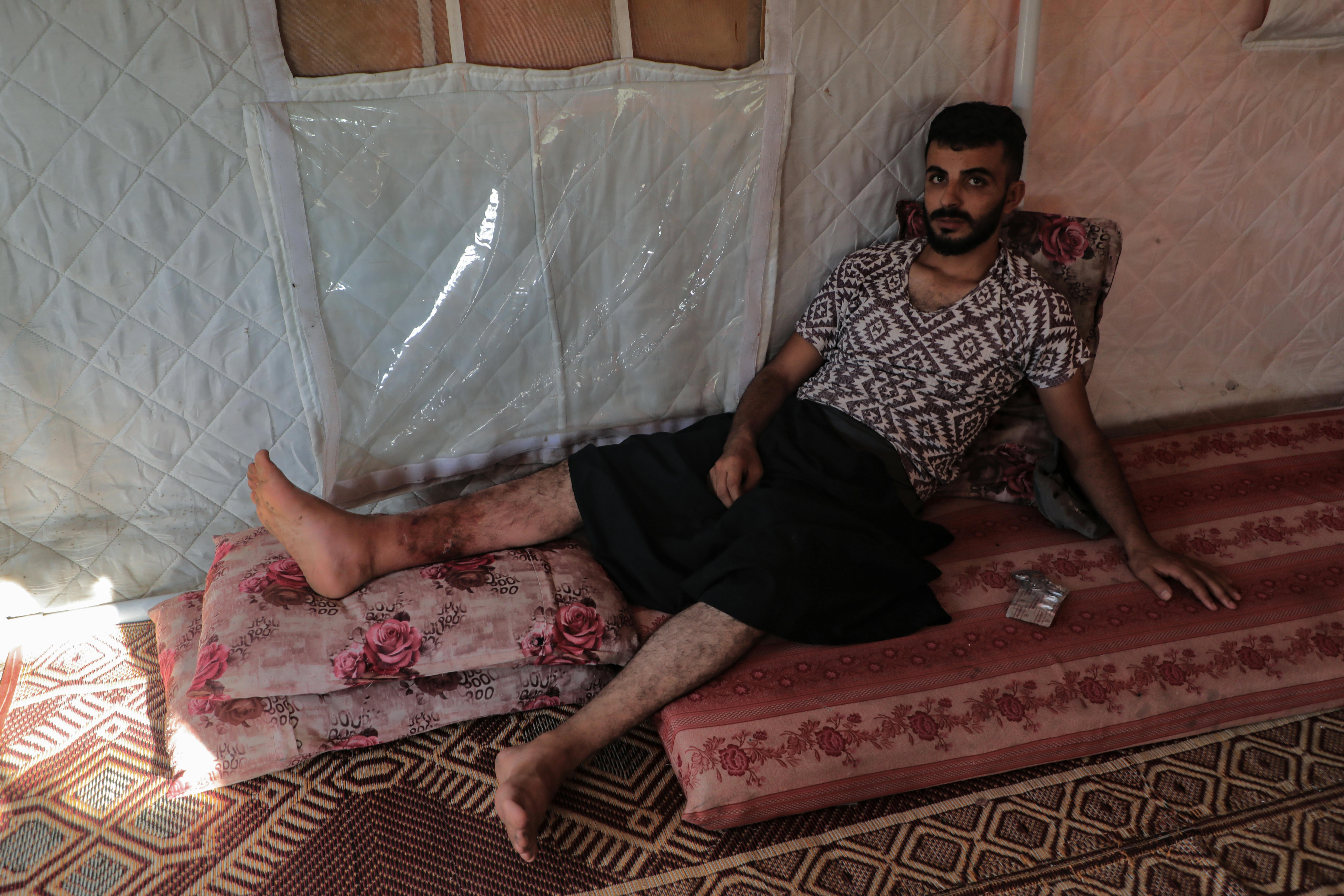 Masoud ha percorso tutto il tragitto dal nord di Gaza fino a un punto di distribuzione a Rafah, nell'estremo sud, sperando di ottenere cibo. Invece è stato ferito alla gamba e ora la sua ferita è infetta.