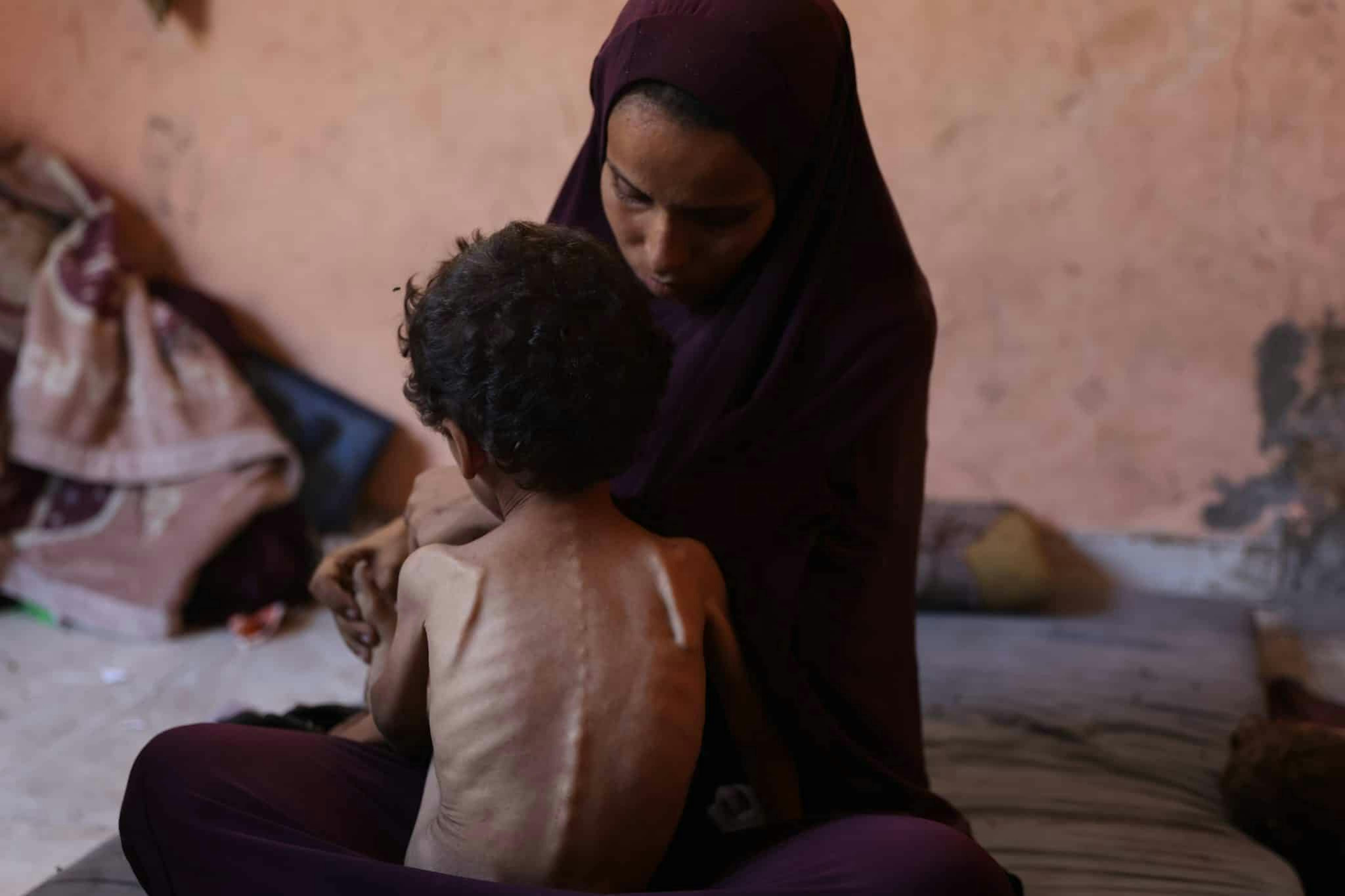 A Gaza, Yazan, due anni, soffre di grave malnutrizione. Sua madre, Naima, racconta: 