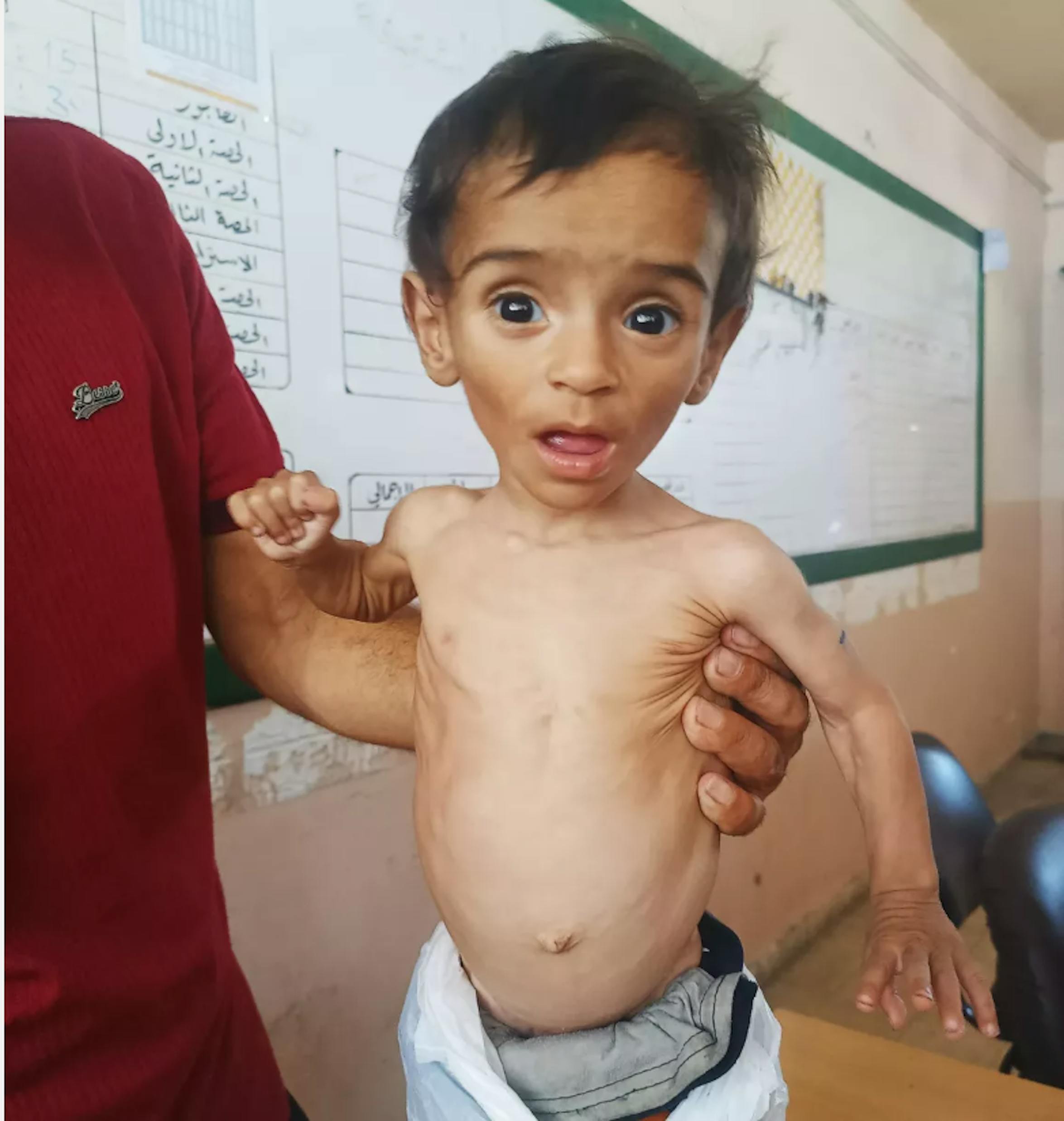 Il piccolo Oday, 10 mesi, era gravemente malnutrito: gli zii sono stati indirizzati in un centro di riabilitazione nutrizionale e in poco tempo ha ripreso a sorridere. Siamo nella Striscia di Gaza, dove a due anni dall'inizio del conflitto è stato confermato lo stato di carestia