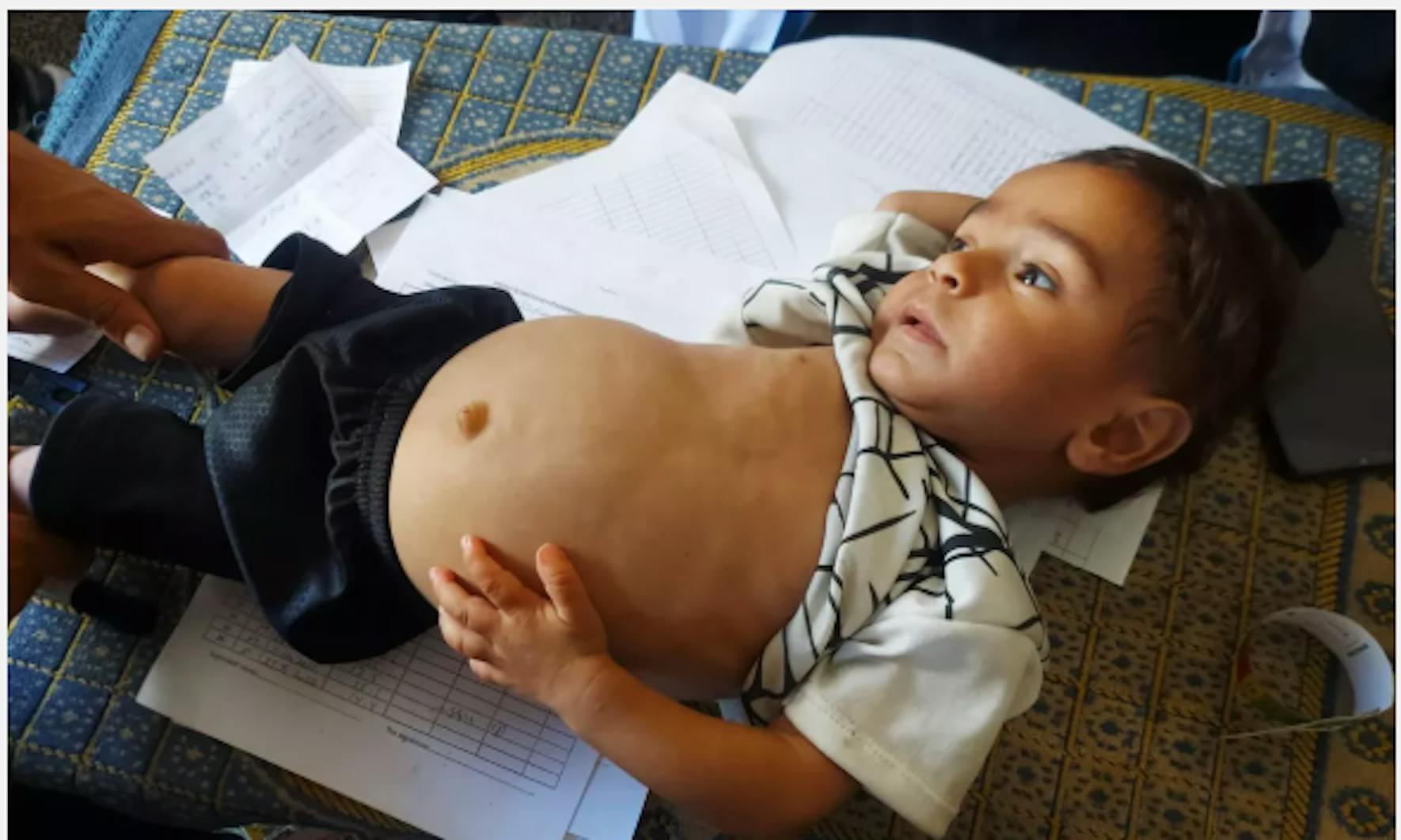 Oday, curato per malnutrizione acuta è tornato a sorridere. Oday è tornato a sorridere: la circonferenza del braccio misurava 11,2 cm e il suo corpo stava riprendendo le forme. Striscia di Gaza 2025