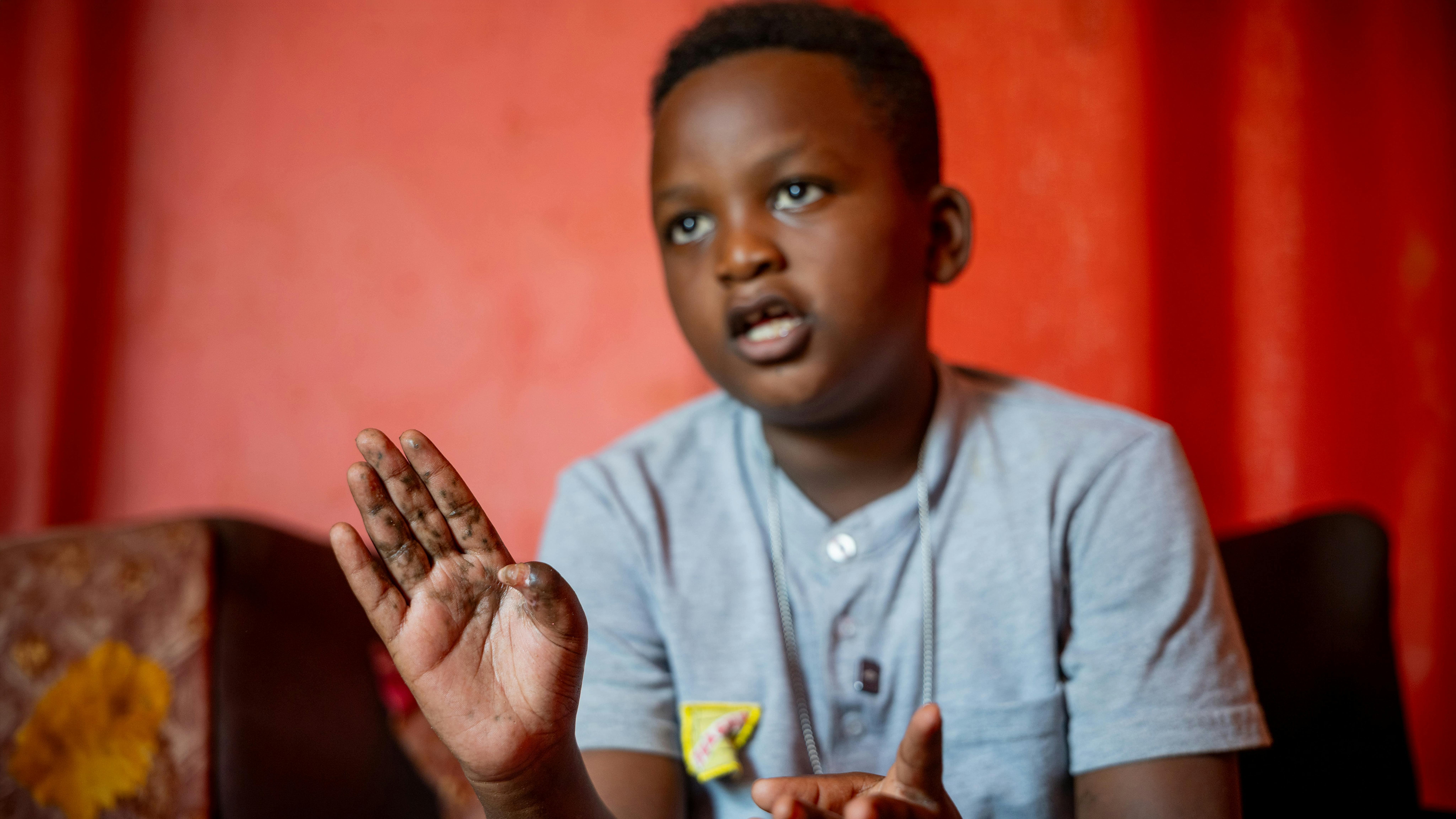 Sudan: Omer, 10 anni, racconta le conseguenze dell’incidente che lo ha ferito mentre si trovava nella sua abitazione temporanea. Il bambino è in fase di recupero dopo aver accidentalmente toccato e maneggiato un residuato bellico inesploso.