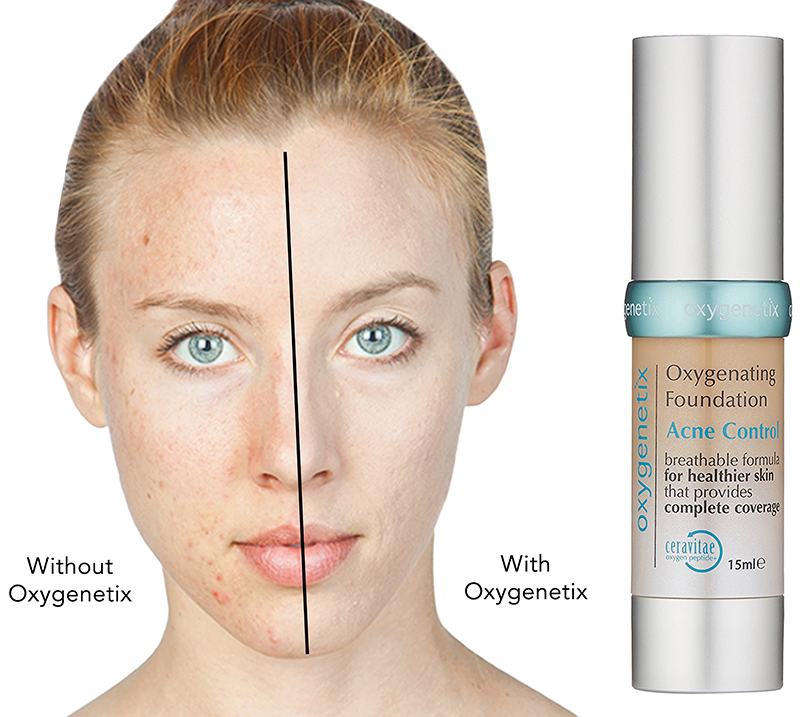 acne control foundation before and after