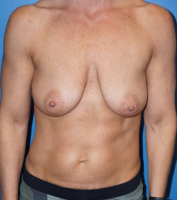 Breast Lift Gallery - Patient 5226471 - Image 1