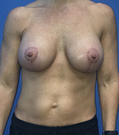 Breast Lift Gallery - Patient 5226471 - Image 2