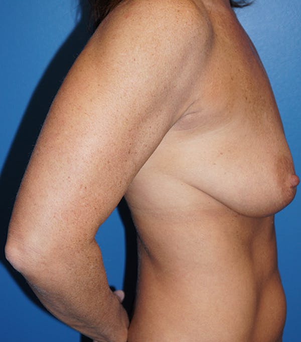 Breast Lift Gallery - Patient 5226471 - Image 3