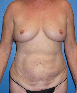 67 Year Old Patient - Before & After Breast Augmentation & Tummy Tuck