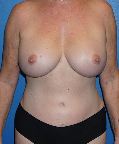 Breast Augmentation Gallery - Patient 5226524 - Image 2