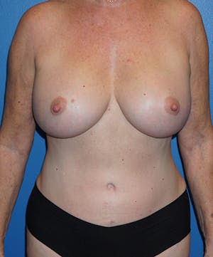 67 Year Old Patient - Before & After Breast Augmentation & Tummy Tuck