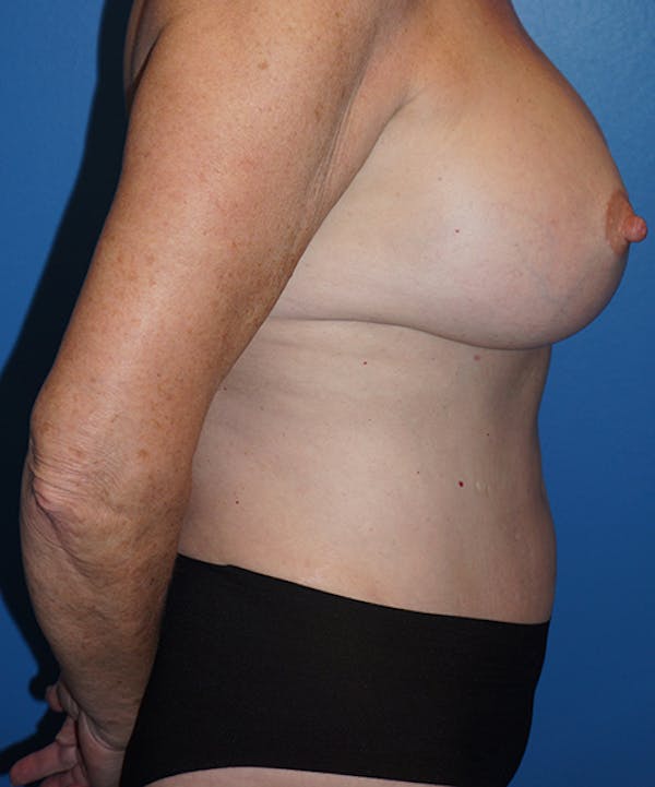 Breast Augmentation Gallery - Patient 5226524 - Image 6
