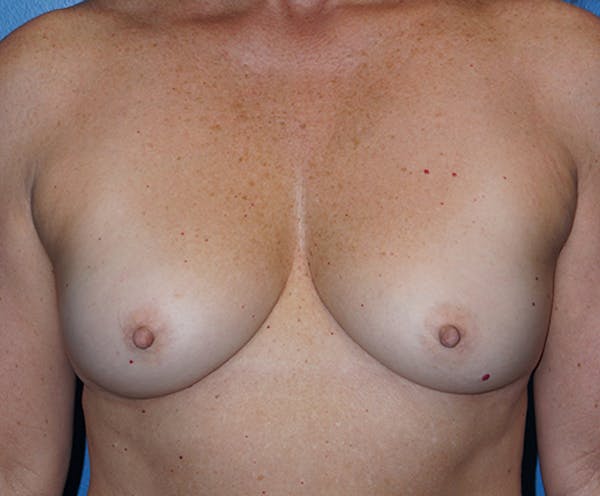 Breast Augmentation Gallery - Patient 5226530 - Image 1