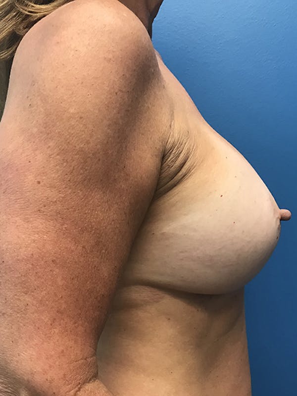 Breast Augmentation Gallery - Patient 5226530 - Image 6