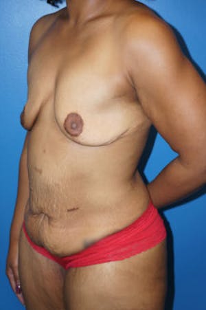 30 Year Old Breast Augmentation Following Massive Weight Loss
