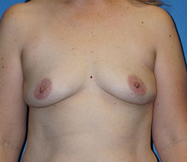 Breast Augmentation Gallery - Patient 5226583 - Image 1