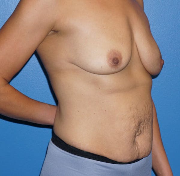 Mommy Makeover in Houston - Before & After with Dr. Lind
