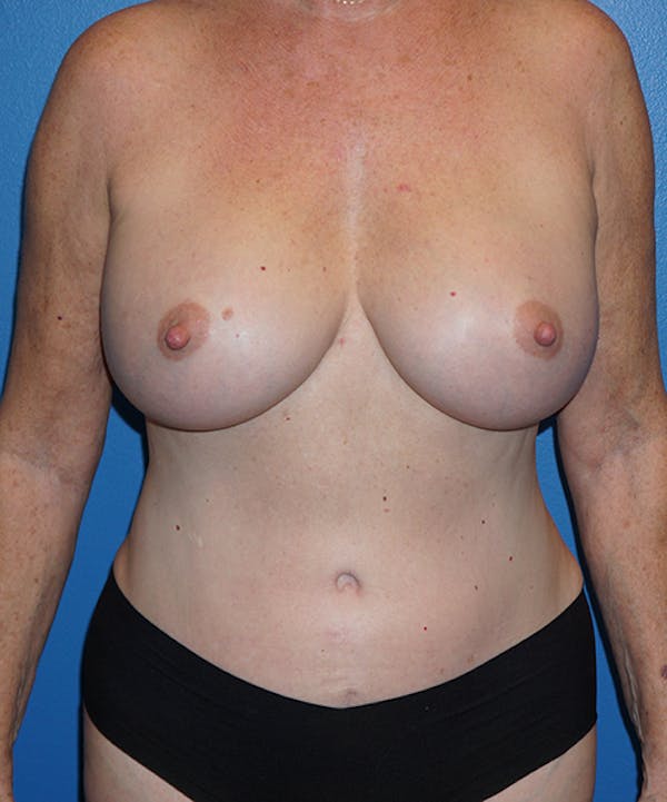 Mommy Makeover Gallery - Patient 5226726 - Image 2