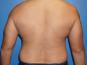 Before and after liposuction on a male abdomen and flanks