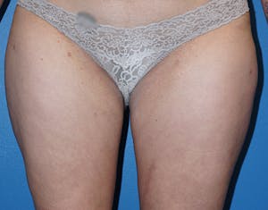 Before and after thigh liposuction with Dr. Lind in Houston