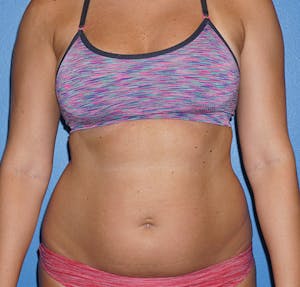 Before and After Photos of Liposuction in Houston TX