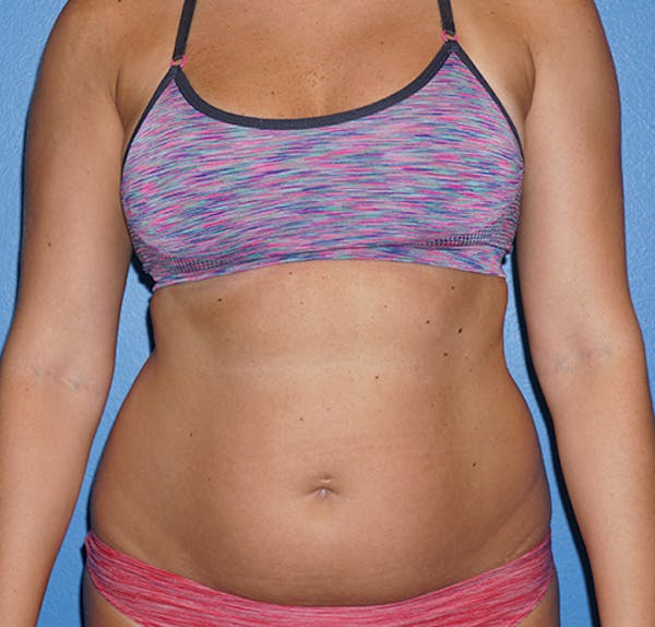 Liposuction Gallery - Patient 5227136 - Image 1